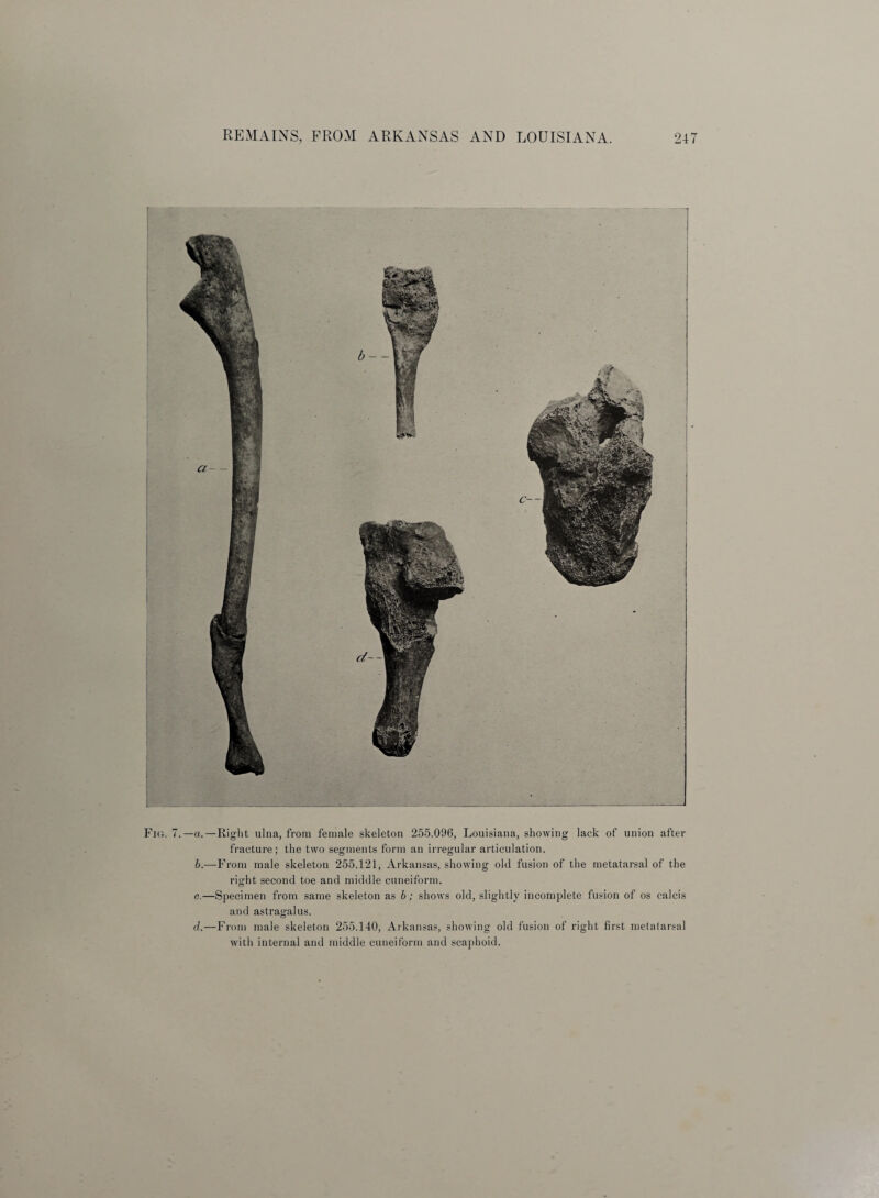 Fig. 7.—a.—Right ulna, from female skeleton 255.096, Louisiana, showing lack of union after fracture; the two segments form an irregular articulation. b. —From male skeleton 255.121, Arkansas, showing old fusion of the metatarsal of the right second toe and middle cuneiform. c. —Specimen from same skeleton as b; shows old, slightly incomplete fusion of os calcis and astragalus. d. —From male skeleton 255.140, Arkansas, showing old fusion of right first metatarsal with internal and middle cuneiform and scaphoid.