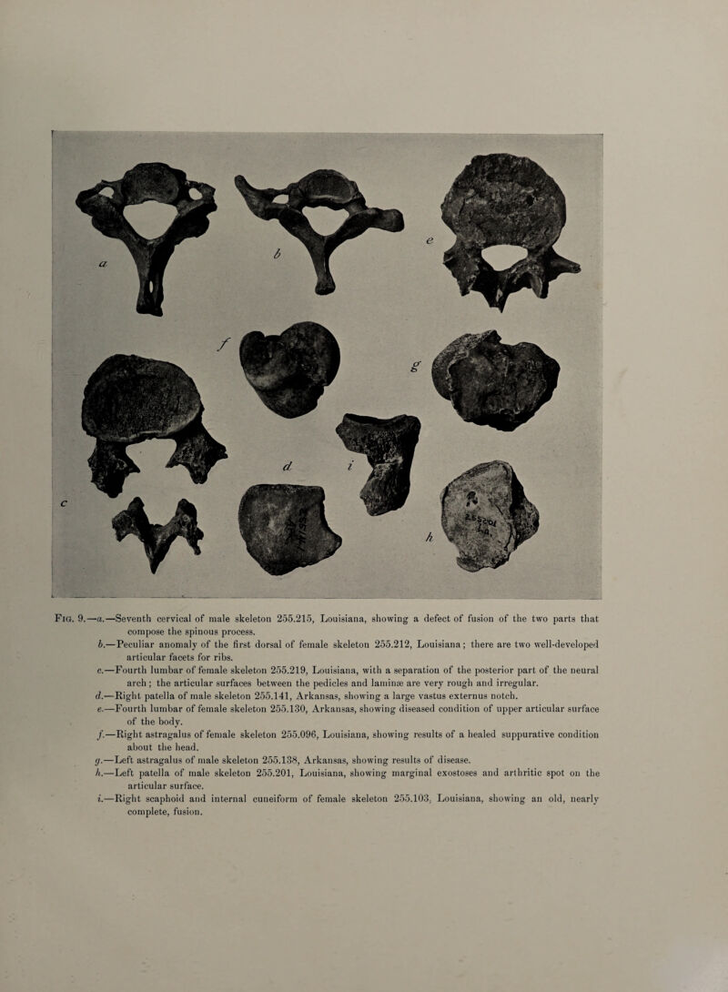 Fig. 9.—a.—Seventh cervical of male skeleton 255.215, Louisiana, showing a defect of fusion of the two parts that compose the spinous process. b. —Peculiar anomaly of the first dorsal of female skeleton 255.212, Louisiana; there are two well-developed articular facets for ribs. c. —Fourth lumbar of female skeleton 255.219, Louisiana, with a separation of the posterior part of the neural arch ; the articular surfaces between the pedicles and laminae are very rough and irregular. d. —Right patella of male skeleton 255.141, Arkansas, showing a large vastus externus notch. e. —Fourth lumbar of female skeleton 255.130, Arkansas, showing diseased condition of upper articular surface of the body. /.—Right astragalus of female skeleton 255.096, Louisiana, showing results of a healed suppurative condition about the head. g. —Left astragalus of male skeleton 255.138, Arkansas, showing results of disease. h. —Left patella of male skeleton 255.201, Louisiana, showing marginal exostoses and arthritic spot on the articular surface. i. —Right scaphoid and internal cuneiform of female skeleton 255.103, Louisiana, showing an old, nearly complete, fusion.