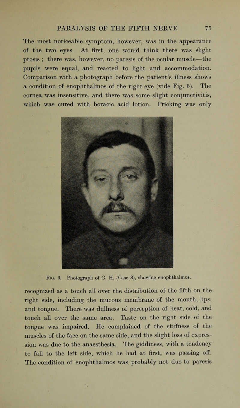 The most noticeable symptom, however, was in the appearance of the two eyes. At first, one would think there was slight ptosis ; there was, however, no paresis of the ocular muscle—the pupils were equal, and reacted to light and accommodation. Comparison with a photograph before the patient’s illness shows a condition of enophthalmos of the right eye (vide Fig. 6). The cornea was insensitive, and there was some slight conjunctivitis, which was cured with boracic acid lotion. Pricking was only Fig. 6. Photograph of G. H. (Case 8), showing enophthalmos. recognized as a touch all over the distribution of the fifth on the right side, including the mucous membrane of the mouth, lips, and tongue. There was dullness of perception of heat, cold, and touch all over the same area. Taste on the right side of the tongue was impaired. He complained of the stiffness of the muscles of the face on the same side, and the slight loss of expres¬ sion was due to the anaesthesia. The giddiness, with a tendency to fall to the left side, which he had at first, was passing off. The condition of enophthalmos was probably not due to paresis