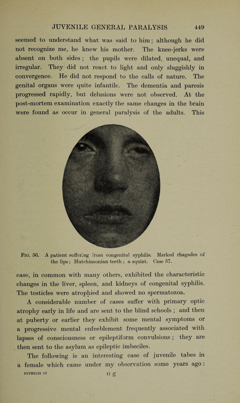 seemed to understand what was said to him; although he did not recognize me, he knew his mother. The knee-jerks were absent on both sides ; the pupils were dilated, unequal, and irregular. They did not react to light and only sluggishly in convergence. He did not respond to the calls of nature. The genital organs were quite infantile. The dementia and paresis progressed rapidly, but delusions were not observed. At the post-mortem examination exactly the same changes in the brain were found as occur in general paralysis of the adults. This Fig. 56. A patient suffering from congenital syphilis. Marked rhagades of the lips; Hutchinsonian teeth ; a squint. Case 57. case, in common with many others, exhibited the characteristic changes in the liver, spleen, and kidneys of congenital syphilis. The testicles were atrophied and showed no spermatozoa. A considerable number of cases suffer with primary optic atrophy early in life and are sent to the blind schools ; and then at puberty or earlier they exhibit some mental symptoms or a progressive mental enfeeblement frequently associated with lapses of consciousness or epileptiform convulsions ; they are then sent to the asylum as epileptic imbeciles. The following is an interesting case of juvenile tabes in a female which came under my observation some years ago : SYPHILIS IY G g