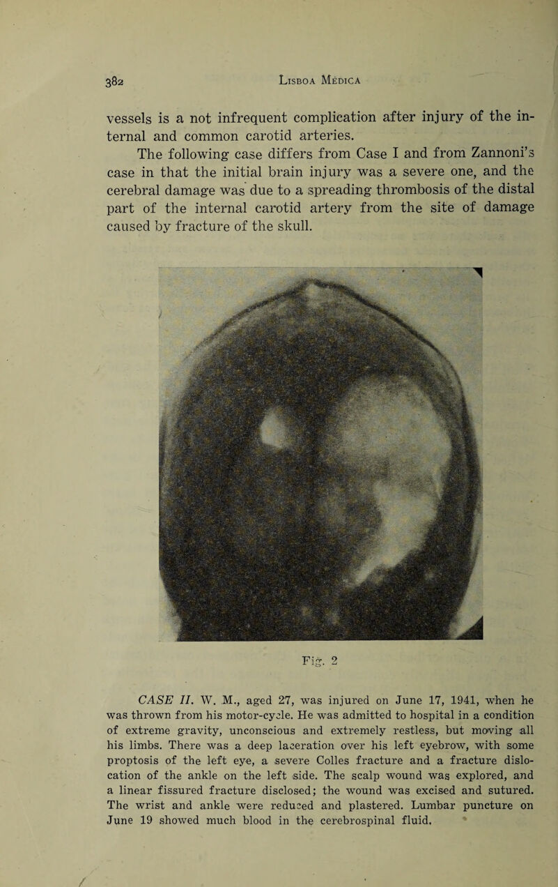 vessels is a not infrequent complication after injury of the in¬ ternal and common carotid arteries. The following case differs from Case I and from Zannoni’s case in that the initial brain injury was a severe one, and the cerebral damage was due to a spreading thrombosis of the distal part of the internal carotid artery from the site of damage caused by fracture of the skull. Fig. 2 CASE II. W. M., aged 27, was injured on June 17, 1941, when he was thrown from his motor-cycle. He was admitted to hospital in a condition of extreme gravity, unconscious and extremely restless, but moving all his limbs. There was a deep laceration over his left eyebrow, with some proptosis of the left eye, a severe Colles fracture and a fracture dislo¬ cation of the ankle on the left side. The scalp wound was explored, and a linear fissured fracture disclosed; the wound was excised and sutured. The wrist and ankle were reduced and plastered. Lumbar puncture on June 19 showed much blood in the cerebrospinal fluid.