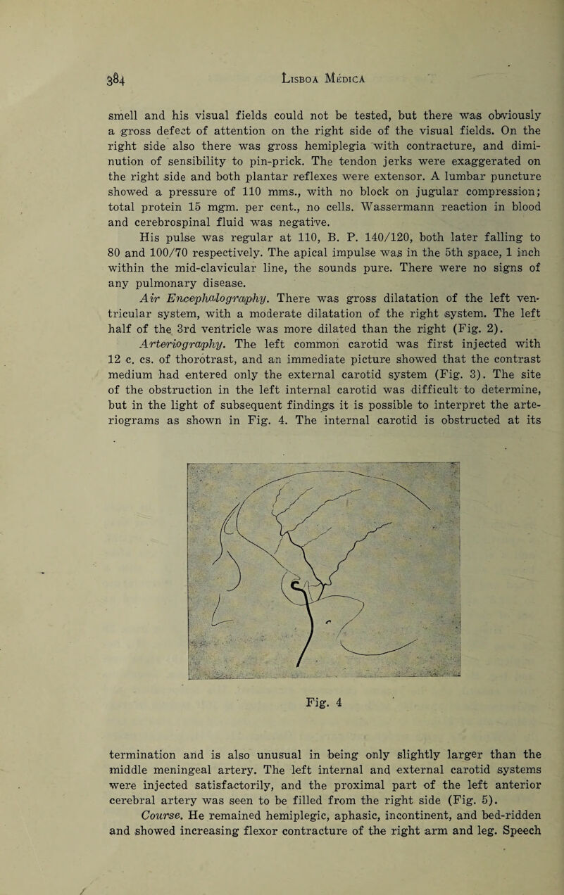 smell and his visual fields could not be tested, but there was obviously a gross defect of attention on the right side of the visual fields. On the right side also there was gross hemiplegia with contracture, and dimi¬ nution of sensibility to pin-prick. The tendon jerks were exaggerated on the right side and both plantar reflexes were extensor. A lumbar puncture showed a pressure of 110 mms., with no block on jugular compression; total protein 15 mgm. per cent., no cells. Wassermann reaction in blood and cerebrospinal fluid was negative. His pulse was regular at 110, B. P. 140/120, both later falling to 80 and 100/70 respectively. The apical impulse was in the 5th space, 1 inch within the mid-clavicular line, the sounds pure. There were no signs of any pulmonary disease. Air EnoephaZography. There was gross dilatation of the left ven¬ tricular system, with a moderate dilatation of the right system. The left half of the 3rd ventricle was more dilated than the right (Fig. 2). Arteriography. The left common carotid was first injected with 12 c. cs. of thorotrast, and an immediate picture showed that the contrast medium had entered only the external carotid system (Fig. 3). The site of the obstruction in the left internal carotid was difficult to determine, but in the light of subsequent findings it is possible to interpret the arte¬ riograms as shown in Fig. 4. The internal carotid is obstructed at its termination and is also unusual in being only slightly larger than the middle meningeal artery. The left internal and external carotid systems were injected satisfactorily, and the proximal part of the left anterior cerebral artery was seen to be filled from the right side (Fig. 5). Course. He remained hemiplegic, aphasic, incontinent, and bed-ridden and showed increasing flexor contracture of the right arm and leg. Speech