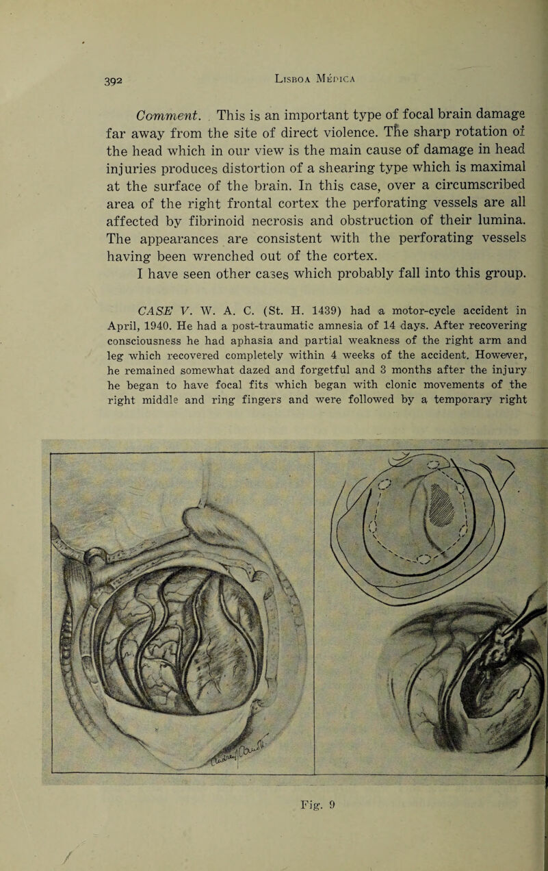 Fig-. 9 Comment. This is an important type of focal brain damage far away from the site of direct violence. The sharp rotation oi the head which in our view is the main cause of damage in head injuries produces distortion of a shearing type which is maximal at the surface of the brain. In this case, over a circumscribed area of the right frontal cortex the perforating vessels are all affected by fibrinoid necrosis and obstruction of their lumina. The appearances are consistent with the perforating vessels having been wrenched out of the cortex. I have seen other cases which probably fall into this group. CASE V. W. A. C. (St. H. 1439) had a motor-cycle accident in April, 1940. He had a post-traumatic amnesia of 14 days. After recovering consciousness he had aphasia and partial weakness of the right arm and leg which recovered completely within 4 weeks of the accident. However, he remained somewhat dazed and forgetful and 3 months after the injury he began to have focal fits which began with clonic movements of the right middle and ring fingers and were followed by a temporary right