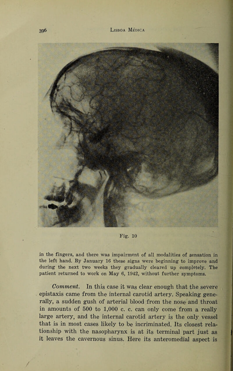 Fig. 10 in the fingers, and there was impairment of all modalities of sensation in the left hand. By January 16 these signs were beginning to improve and during the next two weeks they gradually cleared up completely. The patient returned to work on May 6, 1942, without further symptoms. Comment. In this case it was clear enough that the severe epistaxis came from the internal carotid artery. Speaking gene¬ rally, a sudden gush of arterial blood from the nose and throat in amounts of 500 to 1,000 c. c. can only come from a really large artery, and the internal carotid artery is the only vessel that is in most cases likely to be incriminated. Its closest rela¬ tionship with the nasopharynx is at its terminal part just as it leaves the cavernous sinus. Here its anteromedial aspect is