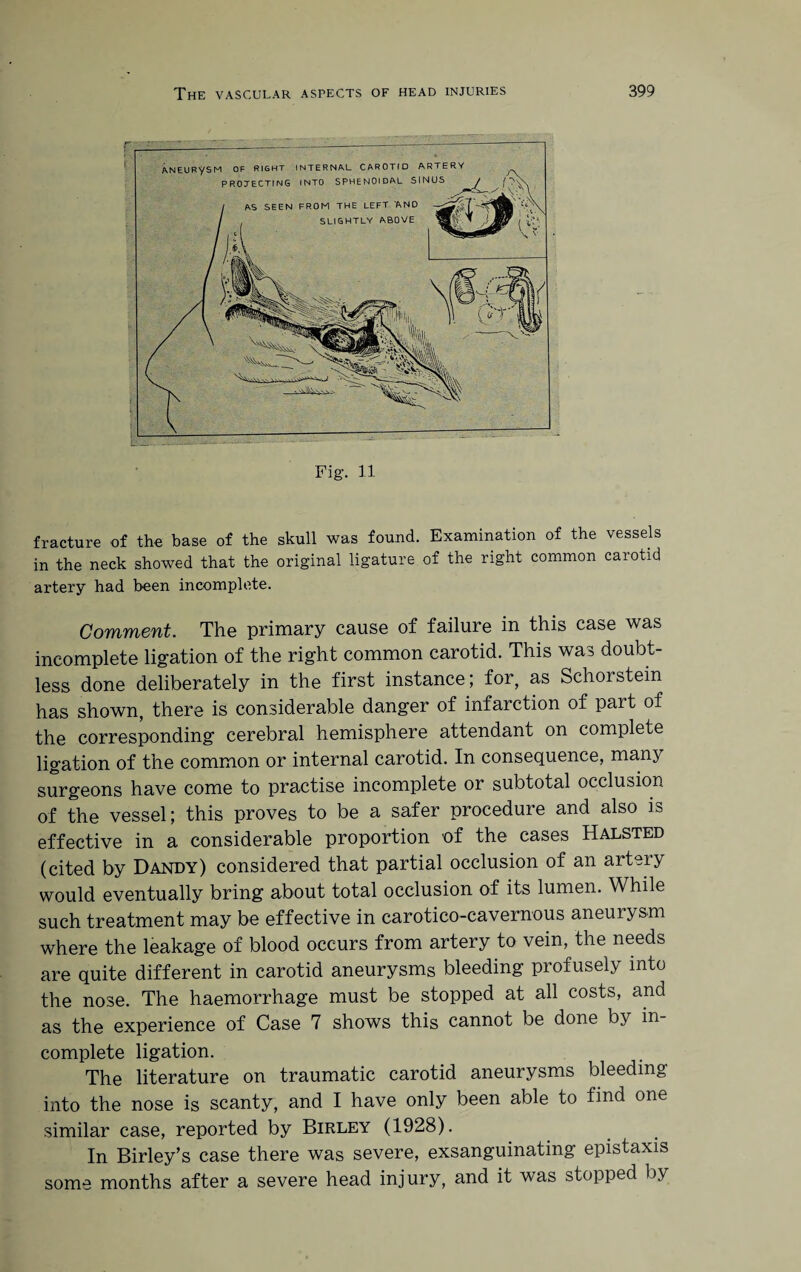 Fig. 11 fracture of the base of the skull was found. Examination of the vessels in the neck showed that the original ligature of the right common carotid artery had been incomplete. Comment. The primary cause of failure in this case was incomplete ligation of the right common carotid. This was doubt¬ less done deliberately in the first instance; for, as Sehorstem has shown, there is considerable danger of infarction of part of the corresponding cerebral hemisphere attendant on complete ligation of the common or internal carotid. In consequence, many surgeons have come to practise incomplete or subtotal occlusion of the vessel; this proves to be a safer procedure and also is effective in a considerable proportion of the cases Halsted (cited by Dandy) considered that partial occlusion of an artery would eventually bring about total occlusion of its lumen. While such treatment may be effective in carotico-cavernous aneurysm where the leakage of blood occurs from artery to vein, the needs are quite different in carotid aneurysms bleeding profusely into the nose. The haemorrhage must be stopped at all costs, and as the experience of Case 7 shows this cannot be done by in¬ complete ligation. The literature on traumatic carotid aneurysms bleeding into the nose is scanty, and I have only been able to find one similar case, reported by Birley (1928). In Birley’s case there was severe, exsanguinating epistaxis some months after a severe head inj ury, and it was stopped by