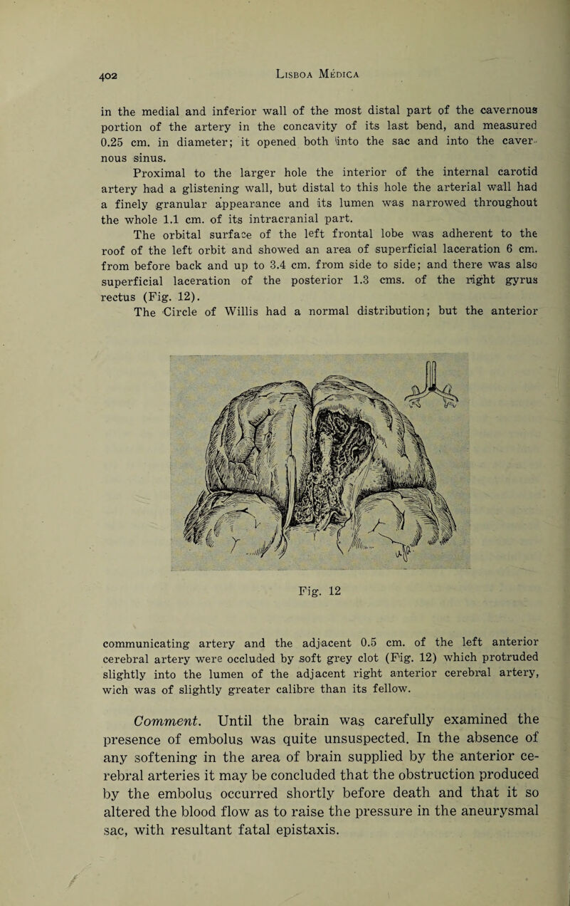 in the medial and inferior wall of the most distal part of the cavernous portion of the artery in the concavity of its last bend, and measured 0.25 cm. in diameter; it opened both 'into the sac and into the caver¬ nous sinus. Proximal to the larger hole the interior of the internal carotid artery bad a glistening wall, but distal to this hole the arterial wall had a finely granular appearance and its lumen was narrowed throughout the whole 1.1 cm. of its intracranial part. The orbital surface of the left frontal lobe was adherent to the roof of the left orbit and showed an area of superficial laceration 6 cm. from before back and up to 3.4 cm. from side to side; and there was also superficial laceration of the posterior 1.3 cms. of the right gyrus rectus (Fig. 12). The Circle of Willis had a normal distribution; but the anterior Fig. 12 communicating artery and the adjacent 0.5 cm. of the left anterior cerebral artery were occluded by soft grey clot (Fig. 12) which protruded slightly into the lumen of the adjacent right anterior cerebral artery, wich was of slightly greater calibre than its fellow. Comment. Until the brain was carefully examined the presence of embolus was quite unsuspected. In the absence of any softening in the area of brain supplied by the anterior ce¬ rebral arteries it may be concluded that the obstruction produced by the embolus occurred shortly before death and that it so altered the blood flow as to raise the pressure in the aneurysmal sac, with resultant fatal epistaxis. /
