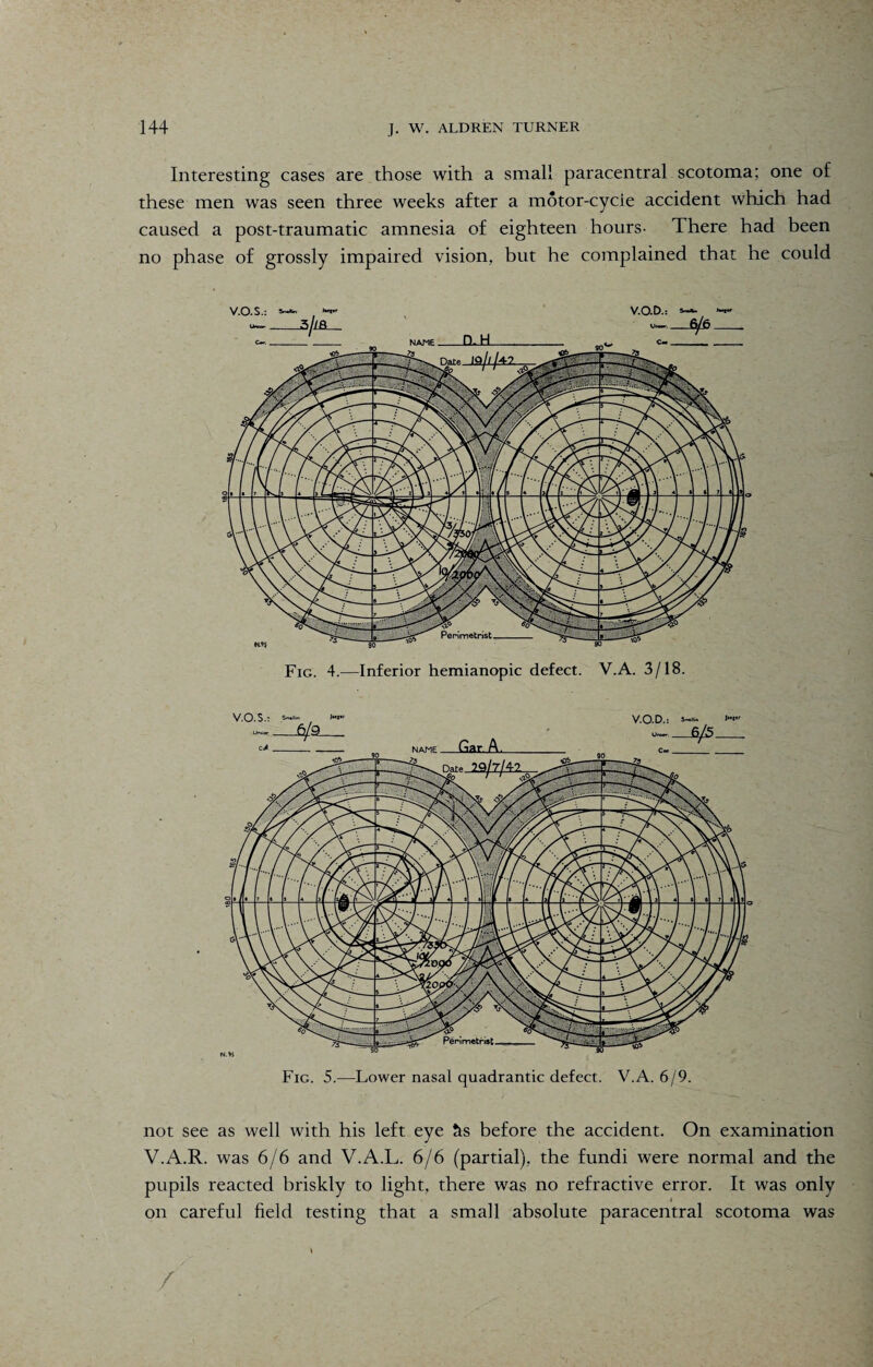 Interesting cases are those with a small paracentral scotoma; one of these men was seen three weeks after a motor-cycie accident which had caused a post-traumatic amnesia of eighteen hours- There had been no phase of grossly impaired vision, but he complained that he could Fig. 4.—Inferior hemianopic defect. V.A. 3/18. Fig. 5.—Lower nasal quadrantic defect. V.A. 6/9. not see as well with his left eye tts before the accident. On examination V.A.R. was 6/6 and V.A.L. 6/6 (partial), the fundi were normal and the pupils reacted briskly to light, there was no refractive error. It was only on careful field testing that a small absolute paracentral scotoma was /