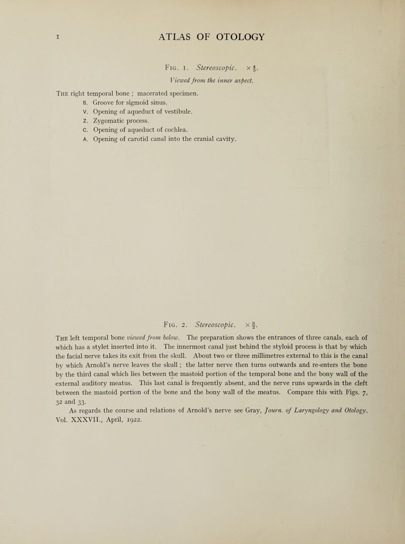 I ATLAS OF OTOLOGY Fig. i. Stereoscopic, x f. Viewed from the inner aspect. The right temporal bone ; macerated specimen. S. Groove for sigmoid sinus. V. Opening of aqueduct of vestibule. Z. Zygomatic process. C. Opening of aqueduct of cochlea. A. Opening of carotid canal into the cranial cavity. Fig. 2. Stereoscopic. xf. The left temporal bone viewed from below. The preparation shows the entrances of three canals, each of which has a stylet inserted into it. The innermost canal just behind the styloid process is that by which the facial nerve takes its exit from the skull. About two or three millimetres external to this is the canal by which Arnold’s nerve leaves the skull; the latter nerve then turns outwards and re-enters the bone by the third canal which lies between the mastoid portion of the temporal bone and the bony wall of the external auditory meatus. This last canal is frequently absent, and the nerve runs upwards in the cleft between the mastoid portion of the bone and the bony wall of the meatus. Compare this with Figs. 7, 32 and 33. As regards the course and relations of Arnold’s nerve see Gray, fourn. of Laryngology and Otology. Vol. XXXVII., April, 1922.