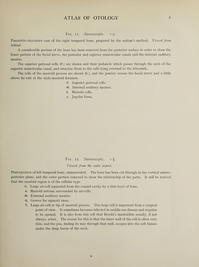 Fig. ii. Stereoscopic. X2. Paraffin-celloidin cast of the right temporal bone, prepared by the author’s method. Viewed from behind. A considerable portion of the bone has been removed from the posterior surface in order to show the lower portion of the facial nerve, the posterior and superior semicircular canals and the internal auditory meatus. The superior petrosal cells (P.) are shown and their peduncle which passes through the arch of the superior semicircular canal, and attaches them to the cells lying external to the labyrinth. The cells of the mastoid process are shown (C.), and the pointer crosses the facial nerve just a little above its exit at the stylo-mastoid foramen. P. Superior petrosal cells. M. Internal auditory meatus. C. Mastoid cells. J. Jugular fossa. Fig. 12. Stereoscopic, xf. Viewed from the outer aspect. Preparation of left temporal bone, unmacerated. The bone has been cut through in the vertical antero¬ posterior plane, and the outer portion removed to show the relationship of the parts. It will be noticed that the mastoid region is of the cellular type. C. Large air-cell separated from the cranial cavity bv a thin layer of bone. A. Mastoid antrum surrounded by air-cells. M. External auditory meatus. G. Groove for sigmoid sinus. T. Large air-cell at tip of mastoid process. This large cell is important from a surgical point of view. It sometimes becomes infected in middle-ear disease and requires to be opened. It is also from this cell that Bezold’s mastoiditis usually, if not always, arises. The reason for this is that the inner wall of the cell is often very thin, and the pus, finding its way through that wall, escapes into the soft tissues under the deep fascia of the neck.