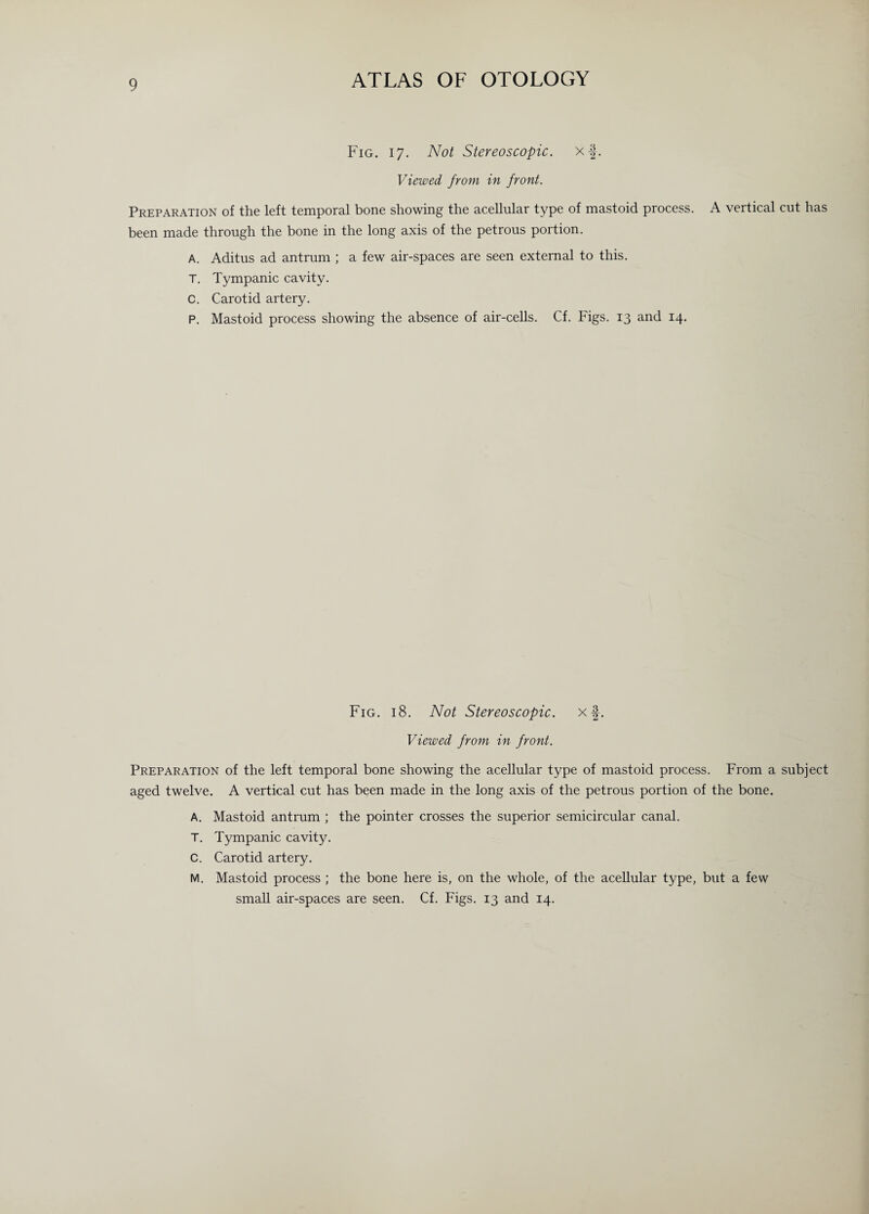 Fig. i 7. Not Stereoscopic, xf. Viewed from in front. Preparation of the left temporal bone showing the acellular type of mastoid process. A vertical cut has been made through the bone in the long axis of the petrous portion. A. Aditus ad antrum ; a few air-spaces are seen external to this. T. Tympanic cavity. C. Carotid artery. P. Mastoid process showing the absence of air-cells. Cf. Figs. 13 and 14. Fig. 18. Not Stereoscopic, xf. Viewed from in front. Preparation of the left temporal bone showing the acellular type of mastoid process. From a subject aged twelve. A vertical cut has been made in the long axis of the petrous portion of the bone. A. Mastoid antrum ; the pointer crosses the superior semicircular canal. T. Tympanic cavity. C. Carotid artery. M. Mastoid process ; the bone here is, on the whole, of the acellular type, but a few small air-spaces are seen. Cf. Figs. 13 and 14.