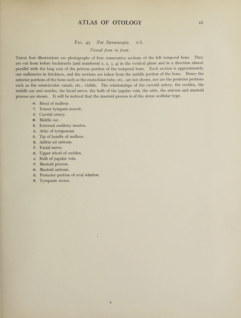 Fig. 43. Not Stereoscopic. x2. Viewed from in front. These four illustrations are photographs of four consecutive sections of the left temporal bone. They are cut from before backwards (and numbered 1, 2, 3, 4) in the vertical plane and in a direction almost parallel with the long axis of the petrous portion of the temporal bone. Each section is approximately one millimetre in thickness, and the sections are taken from the middle portion of the bone. Hence the anterior portions of the bone such as the eustachian tube, etc., are not shown, nor are the posterior portions such as the semicircular canals, etc., visible. The relationships of the carotid artery, the cochlea, the middle ear and ossicles, the facial nerve, the bulb of the jugular vein, the attic, the antrum and mastoid process are shown. It will be noticed that the mastoid process is of the dense acellular type. H. Head of malleus. T. Tensor tympani muscle. C. Carotid artery. M. Middle ear. E. External auditory meatus. A. Attic of tympanum. D. Tip of handle of malleus. B. Aditus ad antrum. F. Facial nerve. G. Upper whorl of cochlea. J. Bulb of jugular vein. P. Mastoid process. N. Mastoid antrum. O. Posterior portion of oval window. R. Tympanic recess.