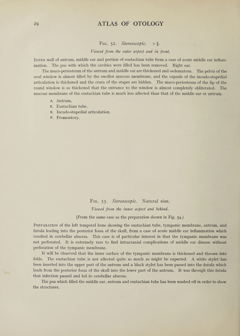 Fig. 52. Stereoscopic, x§. Viewed from the outer aspect and in front. Inner wall of antrum, middle ear and portion of eustachian tube from a case of acute middle ear inflam¬ mation. The pus with which the cavities were filled has been removed. Right ear. The muco-periosteum of the antrum and middle ear are thickened and oedematous. The pelvis of the oval window is almost filled by the swollen mucous membrane, and the capsule of the incudo-stapedial articulation is thickened and the crura of the stapes are hidden. The muco-periosteum of the lip of the round window is so thickened that the entrance to the window is almost completely obliterated. The mucous membrane of the eustachian tube is much less affected than that of the middle ear or antrum. A. Antrum. E. Eustachian tube. S. Incudo-stapedial articulation. P. Promontory. Fig. 53. Stereoscopic. Natural size. Viewed from the inner aspect and behind. (From the same case as the preparation shown in Fig. 54.) Preparation of the left temporal bone showing the eustachian tube, tympanic membrane, antrum, and fistula leading into the posterior fossa of the skull, from a case of acute middle ear inflammation which resulted in cerebellar abscess. This case is of particular interest in that the tympanic membrane was not perforated. It is extremely rare to find intracranial complications of middle ear disease without perforation of the tympanic membrane. It will be observed that the inner surface of the tympanic membrane is thickened and thrown into folds. The eustachian tube is not affected quite so much as might be expected. A white stylet has been inserted into the upper part of the antrum and a black stylet has been passed into the fistula which leads from the posterior fossa of the skull into the lower part of the antrum. It was through this fistula that infection passed and led to cerebellar abscess. The pus which filled the middle ear, antrum and eustachian tube has been washed off in order to show the structures.