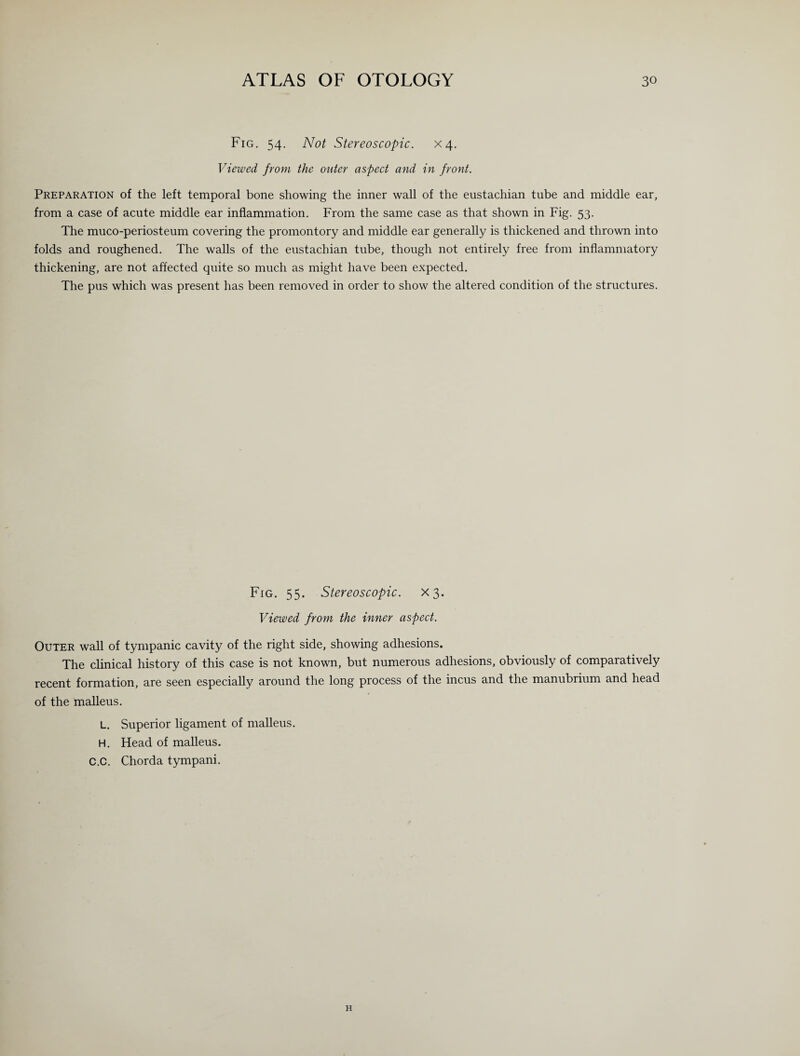 Fig. 54. Not Stereoscopic. X4. Viewed from the outer aspect and in front. Preparation of the left temporal bone showing the inner wall of the eustachian tube and middle ear, from a case of acute middle ear inflammation. From the same case as that shown in Fig. 53. The muco-periosteum covering the promontory and middle ear generally is thickened and thrown into folds and roughened. The walls of the eustachian tube, though not entirely free from inflammatory thickening, are not affected quite so much as might have been expected. The pus which was present has been removed in order to show the altered condition of the structures. Fig. 55. Stereoscopic. X3. Viewed from the inner aspect. Outer wall of tympanic cavity of the right side, showing adhesions. The clinical history of this case is not known, but numerous adhesions, obviously of comparatively recent formation, are seen especially around the long process of the incus and the manubrium and head of the malleus. L. Superior ligament of malleus. H. Head of malleus. C.C. Chorda tympani. H