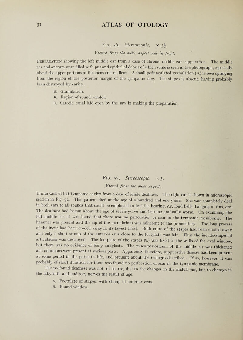 Fig. 56. Stereoscopic. x 3J. Viewed from the outer aspect and in front. Preparation showing the left middle ear from a case of chronic middle ear suppuration. The middle ear and antrum were filled with pus and epithelial debris of which some is seen in the photograph, especially about the upper portions of the incus and malleus. A small pedunculated granulation (G.) is seen springing from the region of the posterior margin of the tympanic ring. The stapes is absent, having probably been destroyed by caries. G. Granulation. R. Region of round window. C. Carotid canal laid open by the saw in making the preparation. Fig. 57. Stereoscopic. X5. . Viewed from the outer aspect. Inner wall of left tympanic cavity from a case of senile deafness. The right ear is shown in microscopic section in Fig. 92. This patient died at the age of a hundred and one years. She was completely deaf in both ears to all sounds that could be employed to test the hearing, e.g. loud bells, banging of tins, etc. The deafness had begun about the age of seventy-five and become gradually worse. On examining the left middle ear, it was found that there was no perforation or scar in the tympanic membrane. The hammer was present and the tip of the manubrium was adherent to the promontory. The long process of the incus had been eroded away in its lowest third. Both crura of the stapes had been eroded away and only a short stump of the anterior crus close to the footplate was left. Thus the incudo-stapedial articulation was destroyed. The footplate of the stapes (S.) was fixed to the walls of the oval window, but there was no evidence of bony ankylosis. The muco-periosteum of the middle ear was thickened and adhesions were present at various parts. Apparently therefore, suppurative disease had been present at some period in the patient’s life, and brought about the changes described. If so, however, it was probably of short duration for there was found no perforation or scar in the tympanic membrane. The profound deafness was not, of course, due to the changes in the middle ear, but to changes in the labyrinth and auditory nerves the result of age. S. Footplate of stapes, with stump of anterior crus. R. Round window.