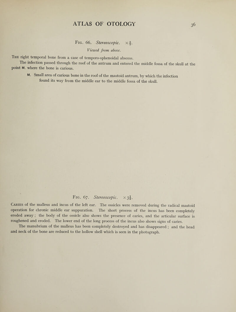 Fig. 66. Stereoscopic, x-f. Viewed from above. The right temporal bone from a case of temporo-sphenoidal abscess. The infection passed through the roof of the antrum and entered the middle fossa of the skull at the point M. where the bone is carious. M. Small area of carious bone in the roof of the mastoid antrum, by which the infection found its way from the middle ear to the middle fossa of the skull. Fig. 67. Stereoscopic, x 3J. Caries of the malleus and incus of the left ear. The ossicles were removed during the radical mastoid operation for chronic middle ear suppuration. The short process of the incus has been completely eroded away ; the body of the ossicle also shows the presence of caries, and the articular surface is roughened and eroded. The lower end of the long process of the incus also shows signs of caries. The manubrium of the malleus has been completely destroyed and has disappeared ; and the head and neck of the bone are reduced to the hollow shell which is seen in the photograph.