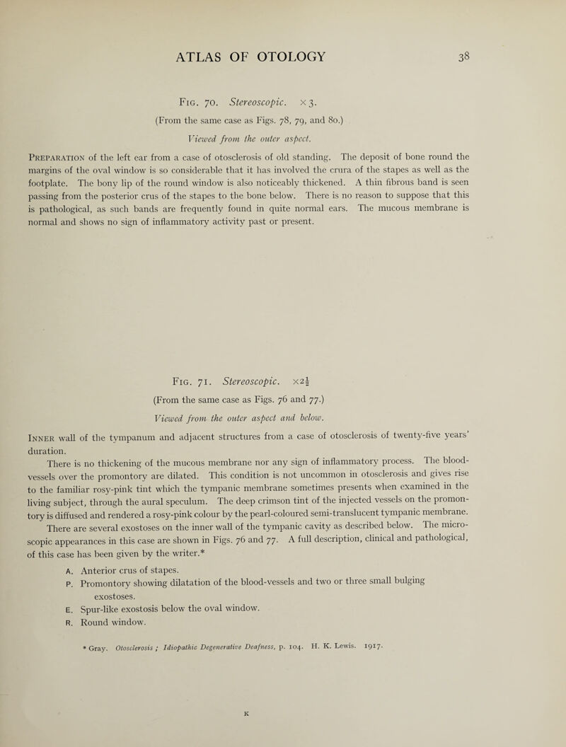 Fig. 70. Stereoscopic. X3. (From the same case as Figs. 78, 79, and 80.) Viewed from the outer aspect. Preparation of the left ear from a case of otosclerosis of old standing. The deposit of bone round the margins of the oval window is so considerable that it has involved the crura of the stapes as well as the footplate. The bony lip of the round window is also noticeably thickened. A thin fibrous band is seen passing from the posterior crus of the stapes to the bone below. There is no reason to suppose that this is pathological, as such bands are frequently found in quite normal ears. The mucous membrane is normal and shows no sign of inflammatory activity past or present. Fig. 71. Stereoscopic. X2| (From the same case as Figs. 76 and 77.) Viewed from the outer aspect and below. Inner wall of the tvnipanum and adjacent structures from a case of otosclerosis of twenty-five years duration. There is no thickening of the mucous membrane nor any sign of inflammatory process. 1 he blood¬ vessels over the promontory are dilated. This condition is not uncommon in otosclerosis and gives rise to the familiar rosy-pink tint which the tympanic membrane sometimes presents when examined in the living subject, through the aural speculum. The deep crimson tint of the injected vessels on the promon¬ tory is diffused and rendered a rosy-pink colour by the pearl-coloured semi-translucent tympanic membrane. There are several exostoses on the inner wall of the tympanic cavity as described below. The micro¬ scopic appearances in this case are shown in Figs. 76 and 77. A full description, clinical and pathological, of this case has been given by the writer.* A. Anterior crus of stapes. P. Promontory showing dilatation of the blood-vessels and two or three small bulging exostoses. E. Spur-like exostosis below the oval window. R. Round window. ♦Gray. Otosclerosis; Idiopathic Degenerative Deafness, p. 104. H. K. Lewis. 1917. K