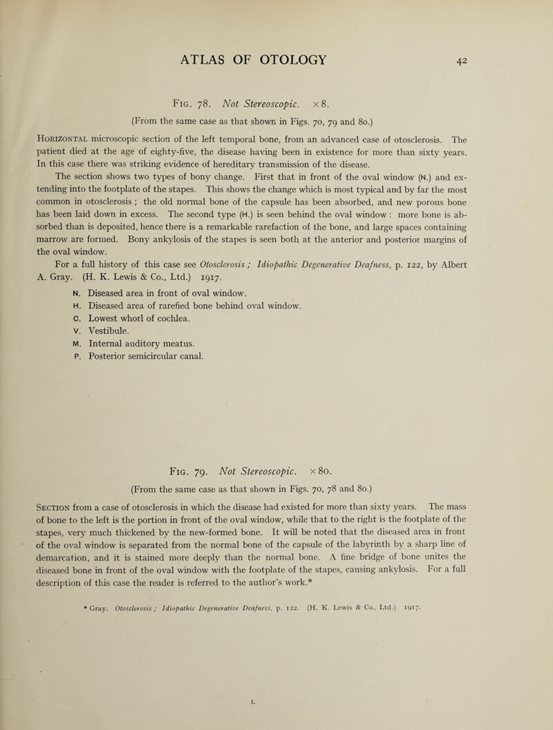 Fig. 78. Not Stereoscopic. x8. (From the same case as that shown in Figs. 70, 79 and 80.) Horizontal microscopic section of the left temporal bone, from an advanced case of otosclerosis. The patient died at the age of eighty-five, the disease having been in existence for more than sixty years. In this case there was striking evidence of hereditary transmission of the disease. The section shows two types of bony change. First that in front of the oval window (N.) and ex¬ tending into the footplate of the stapes. This shows the change which is most typical and by far the most common in otosclerosis ; the old normal bone of the capsule has been absorbed, and new porous bone has been laid down in excess. The second type (H.) is seen behind the oval window : more bone is ab¬ sorbed than is deposited, hence there is a remarkable rarefaction of the bone, and large spaces containing marrow are formed. Bony ankylosis of the stapes is seen both at the anterior and posterior margins of the oval window. For a full history of this case see Otosclerosis ; Idiopathic Degenerative Deafness, p. 122, by Albert A. Gray. (H. K. Lewis & Co., Ltd.) 1917. N. Diseased area in front of oval window. H. Diseased area of rarefied bone behind oval window. C. Lowest whorl of cochlea. V. Vestibule. M. Internal auditory meatus. P. Posterior semicircular canal. Fig. 79. Not Stereoscopic. x8o. (From the same case as that shown in Figs. 70, 78 and 80.) Section from a case of otosclerosis in which the disease had existed for more than sixty years. The mass of bone to the left is the portion in front of the oval window, while that to the right is the footplate of the stapes, very much thickened by the new-formed bone. It will be noted that the diseased area in front of the oval window is separated from the normal bone of the capsule of the labyrinth by a sharp line of demarcation, and it is stained more deeply than the normal bone. A fine bridge of bone unites the diseased bone in front of the oval window with the footplate of the stapes, causing ankylosis. For a full description of this case the reader is referred to the author’s work.* * Gray. Otosclerosis ; Idiopathic Degenerative Deafness, p. 122. (H. K. Lewis & Co., Ltd.) 1917- L