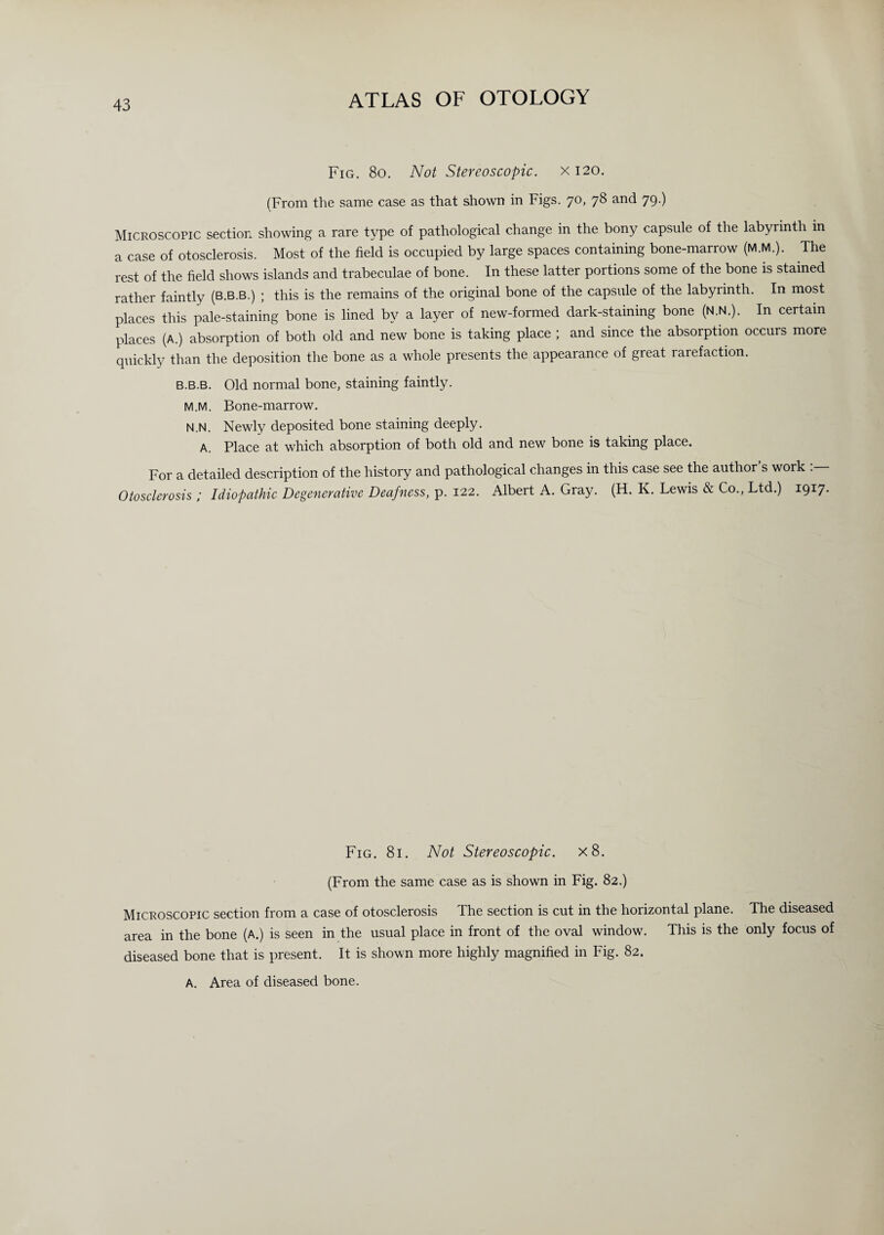 Fig. 8o. Not Stereoscopic, x 120. (From the same case as that shown in Figs. 70, 78 and 79.) Microscotic section showing a rare type of pathological change in the bony capsule of the labyrinth in a case of otosclerosis. Most of the field is occupied by large spaces containing bone-marrow (M.M.). The rest of the field shows islands and trabeculae of bone. In these latter portions some of the bone is stained rather faintly (b.b.b.) ; this is the remains of the original bone of the capsule of the labyrinth. In most places this pale-staining bone is lined by a layer of new-formed dark-staining bone (N.N.). In certain places (A.) absorption of both old and new bone is taking place ; and since the absorption occurs more quickly than the deposition the bone as a whole presents the appearance of great rarefaction. b.b.b. Old normal bone, staining faintly. M. M. Bone-marrow. N. N. Newly deposited bone staining deeply. A. Place at which absorption of both old and new bone is taking place. For a detailed description of the history and pathological changes in this case see the author’s work Otosclerosis; Idiopathic Degenerative Deafness, p. 122. Albert A. Gray. (H. K. Lewis & Co., Ltd.) 1917. Fig. 81. Not Stereoscopic. x8. (From the same case as is shown in Fig. 82.) Microscopic section from a case of otosclerosis The section is cut in the horizontal plane. The diseased area in the bone (A.) is seen in the usual place in front of the oval window. This is the only focus of diseased bone that is present. It is shown more highly magnified in Fig. 82. A. Area of diseased bone.