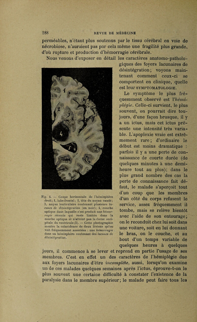 perméables, n’étant plus soutenus par le tissu cérébral en voie de nécrobiose, n’auraient pas par cela même une fragilité plus grande, d’où rupture et production d’hémorragie cérébrale. Nous venons d’exposer en détail les caractères anatomo-patholo¬ giques des foyers lacunaires de désintégration; voyons main¬ tenant comment ceux-ci se comportent en clinique, quelle est leur symptomatologie. Le symptôme le plus fré¬ quemment observé est Yhémi- plégie. Celle-ci survient, le plus souvent, on pourrait dire tou¬ jours, d’une façon brusque, il y a un ictus, mais cet ictus pré¬ sente une intensité très varia¬ ble. L’apoplexie vraie est extrê¬ mement rare ; d’ordinaire le début est moins dramatique : parfois il y a une perte de con¬ naissance de courte durée (de quelques minutes à une demi- heure tout au plus); dans le plus grand nombre des cas la perte de connaissance fait dé¬ faut, le malade s’aperçoit tout d’un coup que les membres d’un côté du corps refusent le service, assez fréquemment il tombe, mais se relève bientôt avec l’aide de son entourage; on le reconduit chez lui soit dans une voiture, soit en lui donnant le bras, on le couche, et au bout d’un temps variable de quelques heures à quelques jours, il commence à se lever et reprend en partie l’usage de ses membres. C’est en effet un des caractères de l’hémiplégie due aux foyers lacunaires d’être incomplète, aussi, lorsqu’on examine un de ces malades quelques semaines après l’ictus, éprouve-t-on le plus souvent une certaine difficulté à constater l’existence de la paralysie dans le membre supérieur; le malade peut faire tous les Fig. 4. — Coupe horizontale de l’hémisphère droit; 1, lobe frontal ; 2, tête du noyau caudé ; 3, noyau lenticulaire contenant plusieurs la¬ cunes de désintégration (en noir); 4, couche optique dans laquelle s’est produit une hémor¬ ragie récente qui reste limitée dans la couche optique et n’atteint pas la corne occi¬ pitale du ventricule (5). — Cette photographie montre la coïncidence de deux lésions qu’on voit fréquemment associées : une hémorragie dans un hémisphère contenant des lacunes de désintégration.