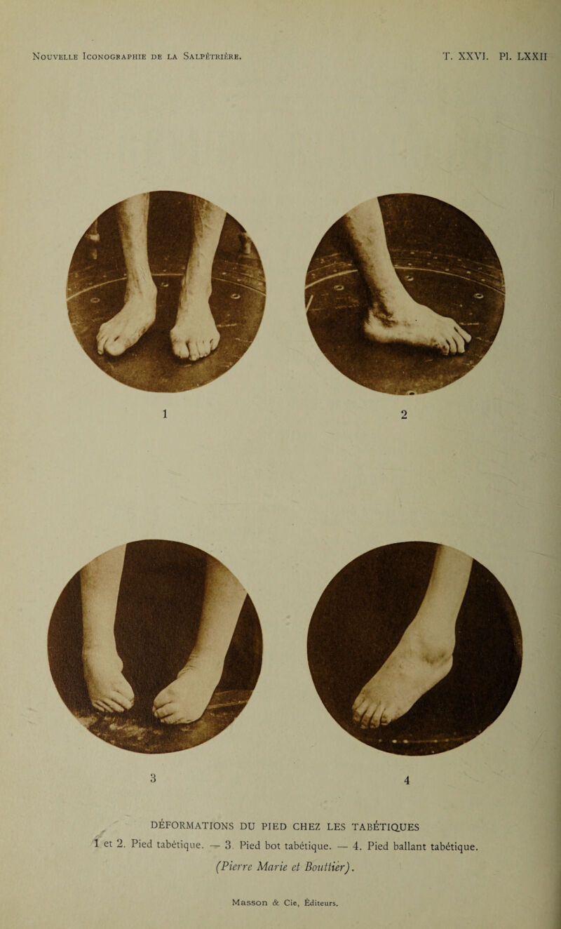 DÉFORMATIONS DU PIED CHEZ LES TABETIQUES 1 et 2. Pied tabétique. — 3. Pied bot tabétique. — 4. Pied ballant tabétique. (Pierre Marie et Bouttier). Masson & Cie, Éditeurs.