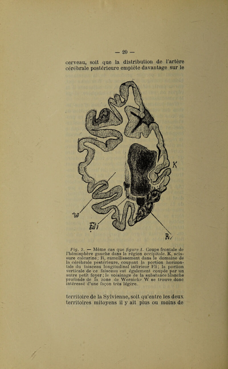 cerveau, soit que la distribution de l’artère cérébrale postérieure empiète davantage sur le Fig. 2. — Même cas que figure 1. Coupe frontale de l’hémisphère gauche dans la région occipitale. K, scis¬ sure calcarine; R, ramollissement dans le domaine de la cérébrale pestérieure, coupant la portion horizon¬ tale du faisceau longitudinal inférieur Fli ; la portion verticale de ce faisceau est également coupée par un autre petit foyer; le voisinage de la substance blanche profonde de la zone de Wernicke W se trouve donc intéressé d’une façon très légère. territoire de la Sylvienne, soit qu’entre les deux territoires mitoyens il y ait plus ou moins de