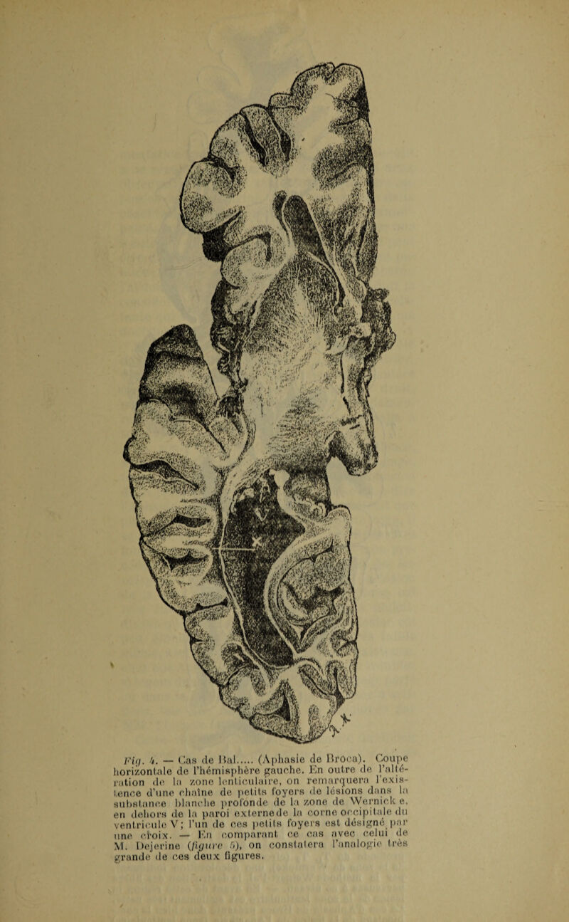 horizontale de l’hémisphère gauche. Jdn outre de l’alté¬ ration de la zone lenticulaire, on remarquera l'exis¬ tence d’une chaîne de petits foyers de lésions dans la substance blanche profonde dé la zone de Wernick e, en dehors de la paroi externe de la corne occipitale du ventricule V; l’un de ces petits foyers est désignerai- une choix. — En comparant ce cas avec celui de M. Dejerine (figure 6), on constatera l’analogie très grande de ces deux figures.
