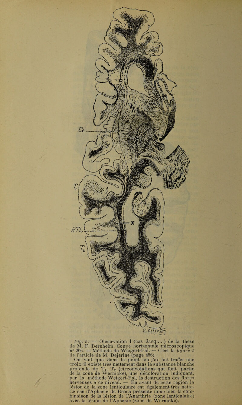 Fig. 5. — Observation I (cas Jacq.) de la thèse de M. F. Bernheim. Coupe horizontale microscopique n° 2G6. — Méthode de Weigert-Pal. — C’est la figure 5 de l’article de M. Dejerine (page 456). On voit que dans le point où j’ai fait trader une croix il existe très nettement dans la substance blanche profonde de T1, T2 (circonvolutions qui font partie de la zone de Wernicke), une décoloration indiquant, par la méthode Weigert-Pal, la destruction des fibres nerveuses à ce niveau. — En avant de cette région la lésion de la zone lenticulaire est également très nette. Ce cas d’Aphasie de Broca présente donc bien la com¬ binaison de la lésion de l’Anarthrie (zone lenticulaire) avec la lésion de l’Aphasie (zone de Wernicke).