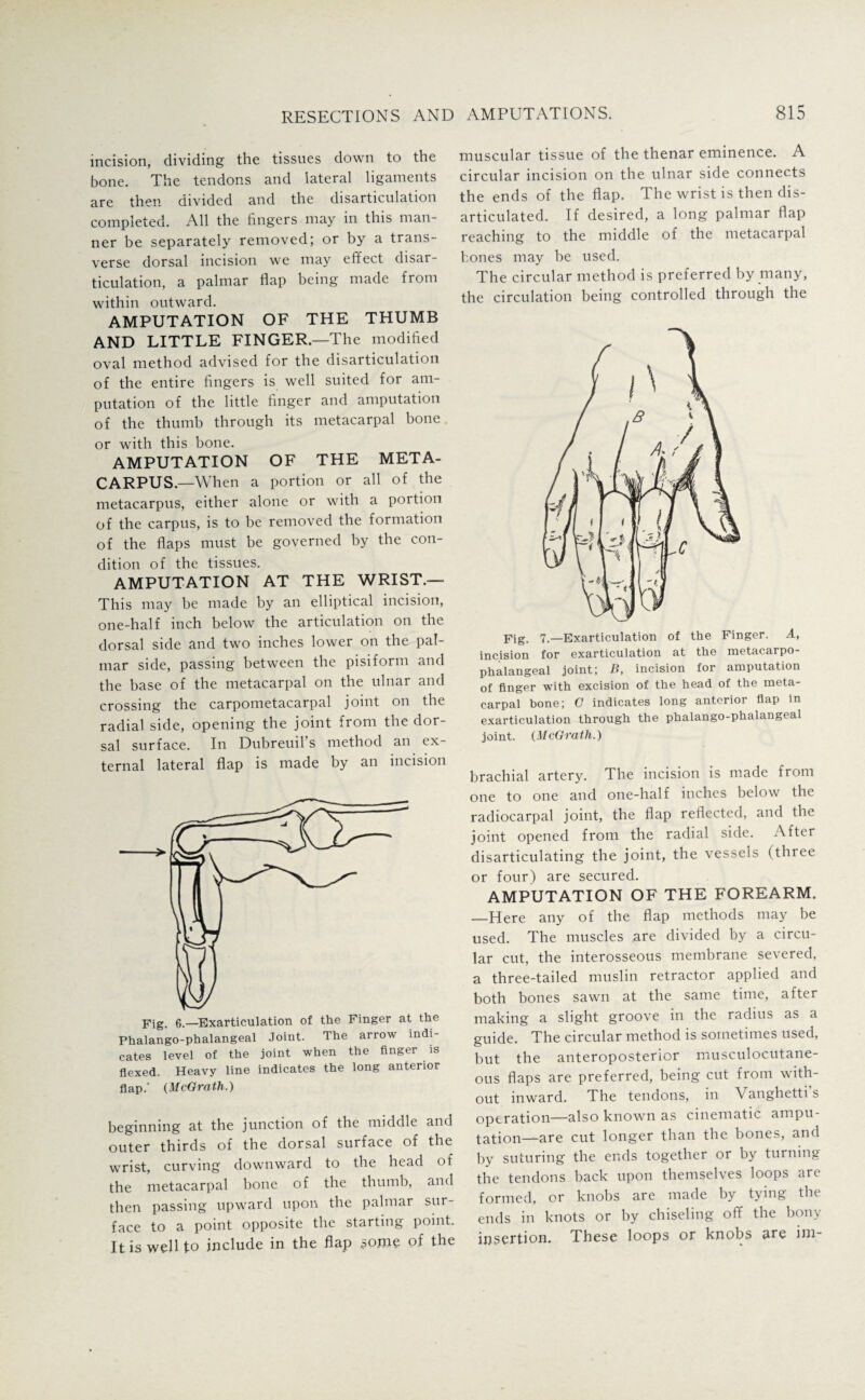 incision, dividing the tissues down to the bone. The tendons and lateral ligaments are then divided and the disarticulation completed. All the fingers may in this man¬ ner be separately removed; or by a trans¬ verse dorsal incision we may effect disar¬ ticulation, a palmar flap being made from within outward. AMPUTATION OF THE THUMB AND LITTLE FINGER—The modified oval method advised for the disarticulation of the entire fingers is well suited for am¬ putation of the little finger and amputation of the thumb through its metacarpal bone or with this bone. AMPUTATION OF THE META¬ CARPUS.—When a portion or all of the metacarpus, either alone or with a portion of the carpus, is to be removed the formation of the flaps must be governed by the con¬ dition of the tissues. AMPUTATION AT THE WRIST — This may be made by an elliptical incision, one-half inch below the articulation on the dorsal side and two inches lower on the pal¬ mar side, passing between the pisiform and the base of the metacarpal on the ulnar and crossing the carpometacarpal joint on the radial side, opening the joint from the dor¬ sal surface. In Dubreuil s method an ex¬ ternal lateral flap is made by an incision Fig. 6.—Exarticulation of the Finger at the Phalango-phalangeal Joint. The arrow indi¬ cates level of the joint when the finger is flexed. Heavy line indicates the long anterior flap.' (McGrath.) beginning at the junction of the middle and outer thirds of the dorsal surface of the wrist, curving downward to the head of the metacarpal bone of the thumb, and then passing upward upon the palmar sur¬ face to a point opposite the starting point. It is well to include in the flap some of the muscular tissue of the thenar eminence. A circular incision on the ulnar side connects the ends of the flap. The wrist is then dis¬ articulated. If desired, a long palmar flap reaching to the middle of the metacarpal bones may be used. The circular method is preferred by many, the circulation being controlled through the Fig. 7.—Exarticulation of the Finger. A, incision for exarticulation at the metacarpo¬ phalangeal joint; B, incision for amputation of finger with excision of the head of the meta¬ carpal bone; G indicates long anterior flap in exarticulation through the phalango-phalangeal joint. (McGrath.) brachial artery. The incision is made from one to one and one-half inches below the radiocarpal joint, the flap reflected, and the joint opened from the radial side. After disarticulating the joint, the vessels (three or four) are secured. AMPUTATION OF THE FOREARM. _Here any of the flap methods may be used. The muscles are divided by a circu¬ lar cut, the interosseous membrane severed, a three-tailed muslin retractor applied and both bones sawn at the same time, after making a slight groove in the radius as a guide. The circular method is sometimes used, but the anteroposterior musculocutane¬ ous flaps are preferred, being cut from with¬ out inward. The tendons, in Vanghetti s operation—also known as cinematic ampu¬ tation—are cut longer than the bones, and by suturing the ends together or by turning the tendons back upon themselves loops are formed, or knobs are made by tying the ends in knots or by chiseling off the bony insertion. These loops or knobs are ini-