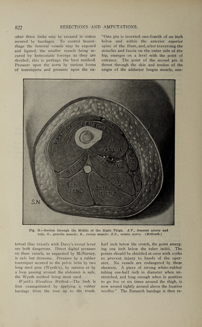 other three limbs may be encased in cotton secured by bandages. To control hemor¬ rhage the femoral vessels may be exposed and ligated, the smaller vessels being se¬ cured by hemostatic forceps as they are divided; this is perhaps the best method. Pressure upon the aorta by various forms of tourniquets and pressure upon the ex- “One pin is inserted one-fourth of an inch below and within the anterior superior spine of the ilium, and, after traversing the muscles and fascia on the outer side of the hip, emerges on a level with the point of entrance. The point of the second pin is thrust through the skin and tendon of the origin of the adductor longus muscle, one- Fig. 19.—Section through the Middle of the Right Thigh. A.V., femoral artery and vein; G., gracilis muscle; R., rectus muscle; S.N., sciatic nerve. (McGrath.) ternal iliac vessels with Davy’s rectal lever are both dangerous. Direct digital pressure on these vessels, as suggested by McBurney, is safe but tiresome. Pressure by a rubber tourniquet secured to the pelvic brim by two long steel pins (Wyeth’s), by sutures or by a loop passing around the abdomen is safe, the Wyeth method being most used. Wyeth’s Bloodless Method.—The limb is first exsanguinated by applying a rubber bandage from the toes up to the trunk. half inch below the crotch, the point emerg¬ ing one inch below the tuber ischii. The points should be shielded at once with corks to prevent injury to hands of the oper¬ ator. No vessels are endangered by these skewei's. A piece of strong white-rubber tubing one-half inch in diameter when un¬ stretched, and long enough when in position to go five or six times around the thigh, is now wound tightly around above the fixation needles.” The Esmarch bandage is then re-