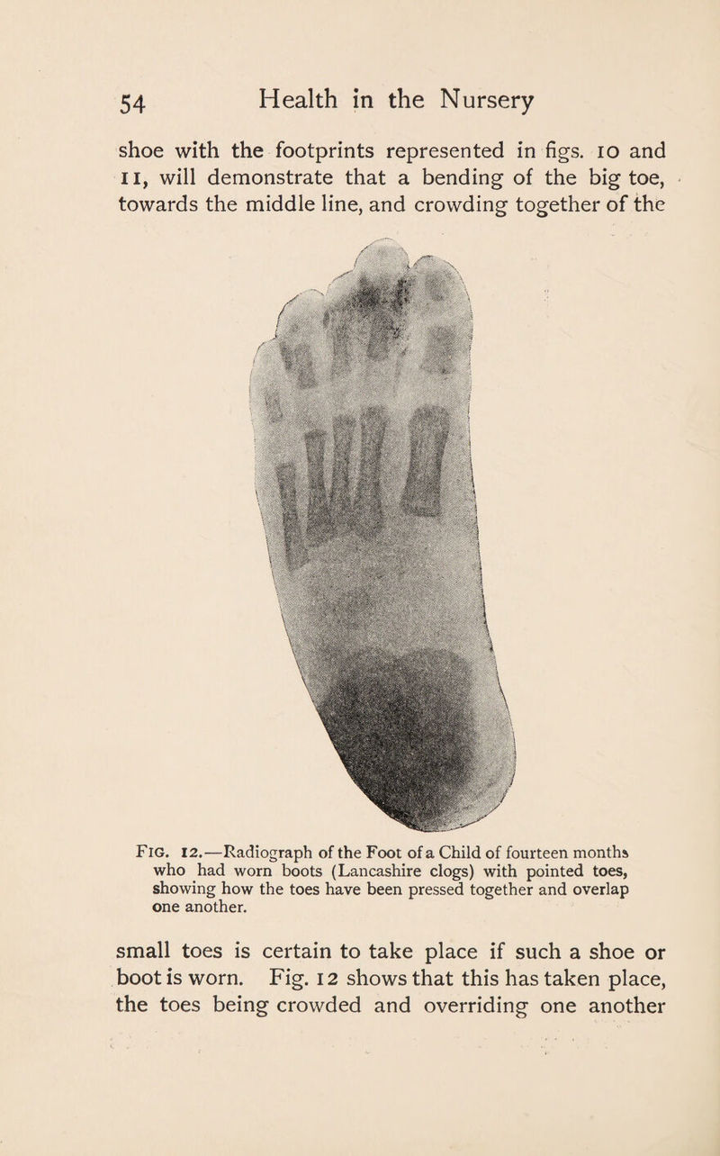 shoe with the footprints represented in figs, io and 11, will demonstrate that a bending of the big toe, towards the middle line, and crowding together of the Fig. 12.—Radiograph of the Foot of a Child of fourteen months who had worn boots (Lancashire clogs) with pointed toes, showing how the toes have been pressed together and overlap one another. small toes is certain to take place if such a shoe or boot is worn. Fig. 12 shows that this has taken place, the toes being crowded and overriding one another