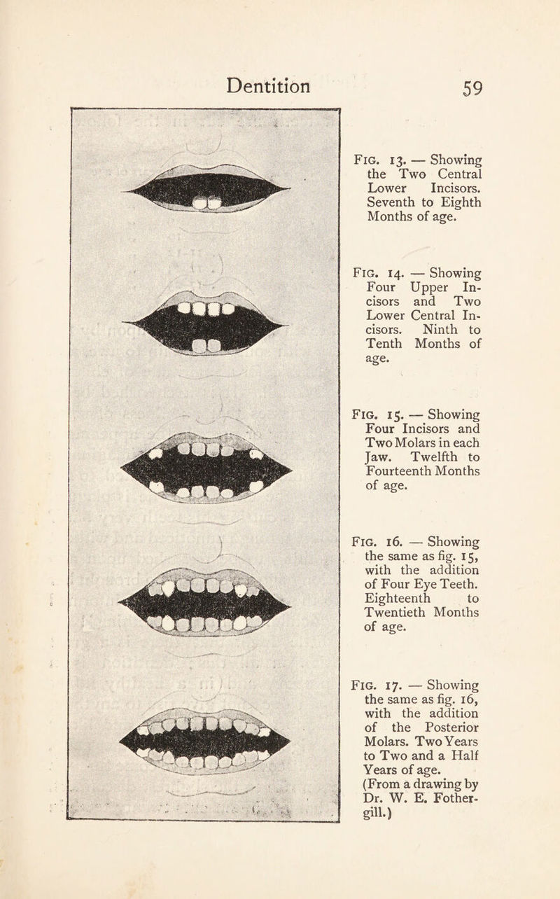 Fig. 13. — Showing the Two Central Lower Incisors. Seventh to Eighth Months of age. Fig. 14. — Showing Four Upper In¬ cisors and Two Lower Central In¬ cisors. Ninth to Tenth Months of age. Fig. 15. — Showing Four Incisors and Two Molars in each Jaw. Twelfth to Fourteenth Months of age. Fig. 16. — Showing the same as fig. 15, with the addition of Four Eye Teeth. Eighteenth to Twentieth Months of age. Fig. 17. — Showing the same as fig. 16, with the addition of the Posterior Molars. Two Years to Two and a Half Years of age. (From a drawing by Dr. W. E. Fother- giU-)