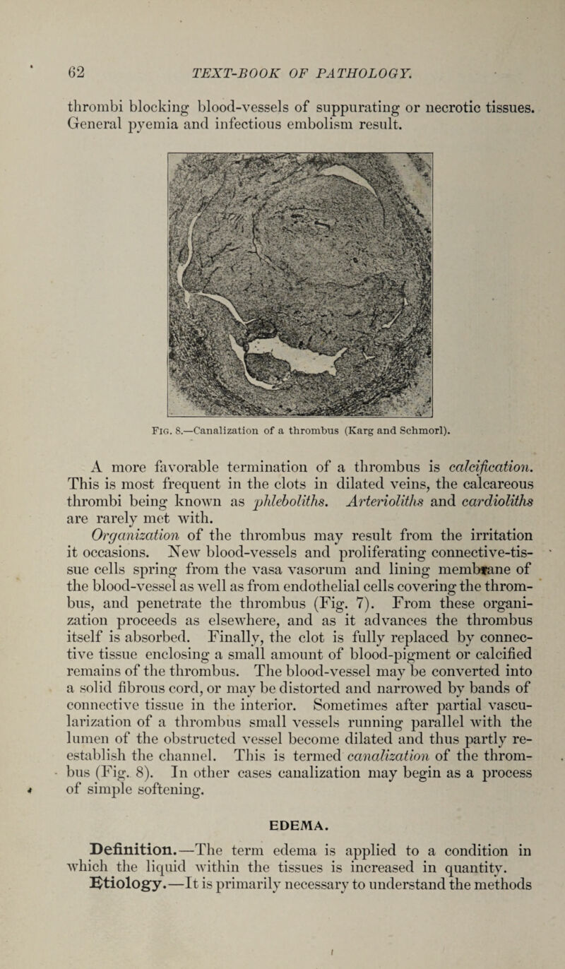 thrombi blocking blood-vessels of suppurating or necrotic tissues. General pyemia and infectious embolism result. Fig. 8.—Canalization of a thrombus (Karg and Schmorl). A more favorable termination of a thrombus is calcification. This is most frequent in the clots in dilated veins, the calcareous thrombi being known as phleboliths. Arteriolitlis and cardioliths are rarely met with. Organization of the thrombus may result from the irritation it occasions. New blood-vessels and proliferating connective-tis¬ sue cells spring from the vasa vasorum and lining membfane of the blood-vessel as well as from endothelial cells covering the throm¬ bus, and penetrate the thrombus (Fig. 7). From these organi¬ zation proceeds as elsewhere, and as it advances the thrombus itself is absorbed. Finally, the clot is fully replaced by connec¬ tive tissue enclosing a small amount of blood-pigment or calcified remains of the thrombus. The blood-vessel may be converted into a solid fibrous cord, or may be distorted and narrowed by bands of connective tissue in the interior. Sometimes after partial vascu¬ larization of a thrombus small vessels running parallel with the lumen of the obstructed vessel become dilated and thus partly re¬ establish the channel. This is termed canalization of the throm- - bus (Fig. 8). In other cases canalization may begin as a process 4 of simple softening. EDEMA. Definition.—The term edema is applied to a condition in which the liquid within the tissues is increased in quantity. Etiology.—It is primarily necessary to understand the methods i