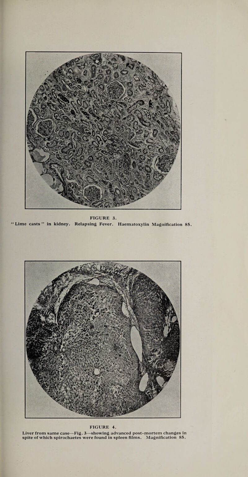 “ Lime casts ” in kidney. Relapsing Fever. Haematoxylin Magnification 85. FIGURE 4. Liver from same case—Fig. 3—showing advanced post-mortem changes in spite of which spirochaetes were found in spleen films. Magnification 85.