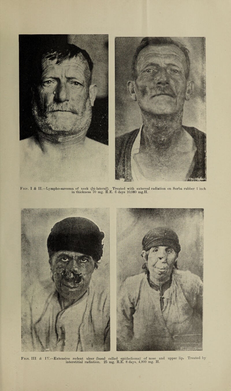 in thickness 70 mg. R.E. 6 days 10,080 mg.H. Figs. Ill & IV.—Extensive rodent ulcer (basal celled epithelioma) of nose and upper lip. Treated by