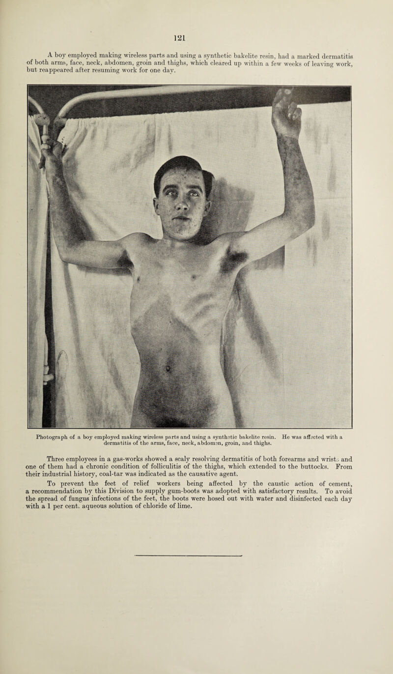 A boy employed making wireless parts and using a synthetic bakelite resin, had a marked dermatitis of both arms, face, neck, abdomen, groin and thighs, which cleared up within a few weeks of leaving work, but reappeared after resuming work for one day. Photograph of a boy employed making wireless parts and using a synthetic bakelite resin. He was affected with a dermatitis of the arms, face, neck, abdomen, groin, and thighs. Three employees in a gas-works showed a scaly resolving dermatitis of both forearms and wrist-, and one of them had a chronic condition of folliculitis of the thighs, which extended to the buttocks. From their industrial history, coal-tar was indicated as the causative agent. To prevent the feet of relief workers being affected by the caustic action of cement, a recommendation by this Division to supply gum-boots was adopted with satisfactory results. To avoid the spread of fungus infections of the feet, the boots were hosed out with water and disinfected each day with a 1 per cent, aqueous solution of chloride of lime.