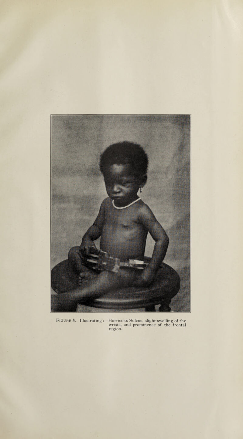 wrists, and prominence of the frontal region.