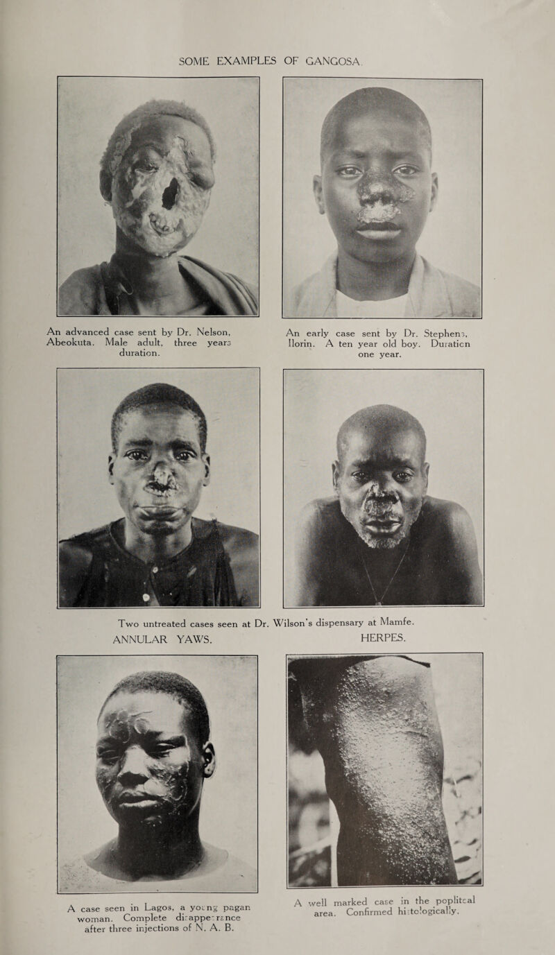 SOME EXAMPLES OF GANGOSA An advanced case sent by Dr. Nelson, Abeokuta. Male adult, three years duration. An early case sent by Dr. Stephens, Ilorin. A ten year old boy. Duration one year. Two untreated cases seen at Dr. Wilson s dispensary at Mamfe. ANNULAR YAWS. HERPES. A case seen in Lagos, a young pagan woman. Complete dirappe: r-nce after three injections of N. A. B. A well marked case in the popliteal area. Confirmed hi-tologically.
