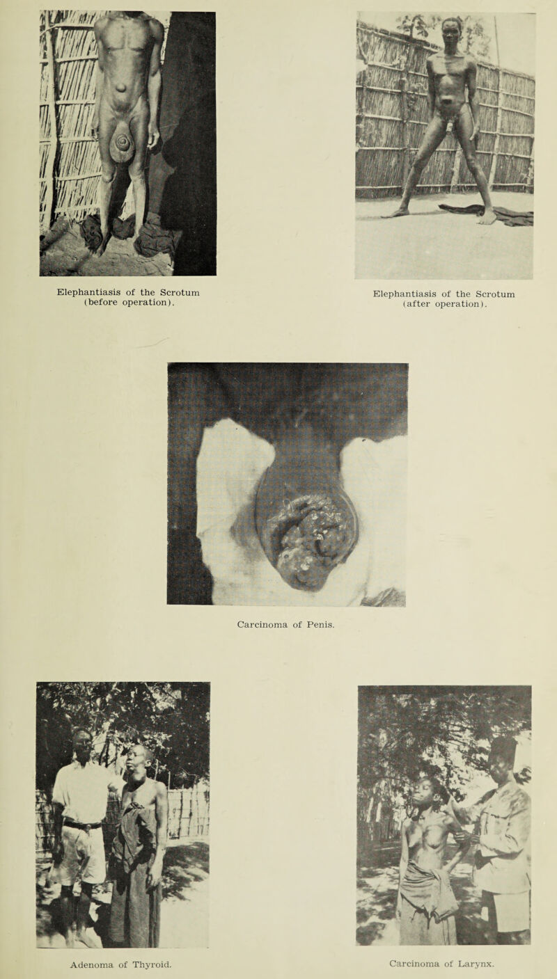 r»*-r ^ Elephantiasis of the Scrotum (before operation). Elephantiasis of the Scrotum (after operation). Carcinoma of Penis. Adenoma of Thyroid. Carcinoma of Larynx.