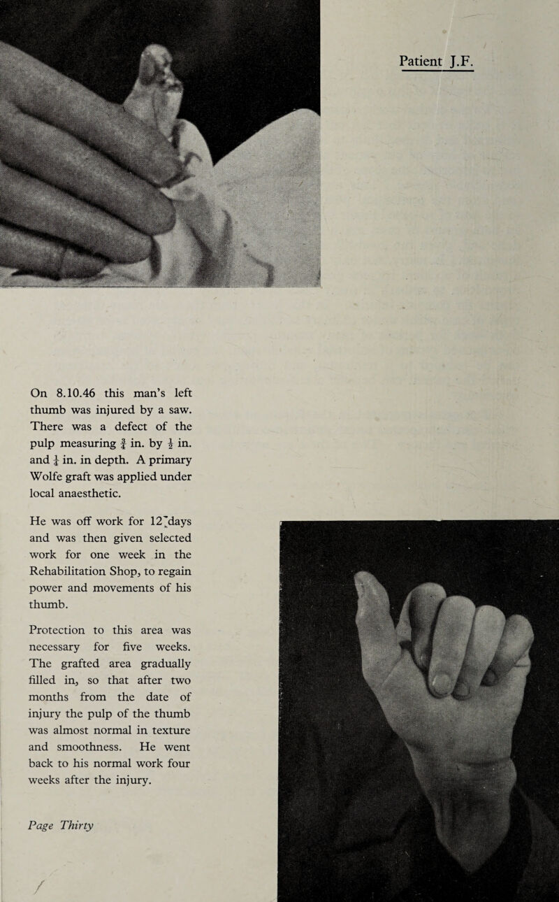 Patient J.F. On 8.10.46 this man’s left thumb was injured by a saw. There was a defect of the pulp measuring f in. by i in. and i in. in depth. A primary Wolfe graft was applied under local anaesthetic. He was off work for 12'days and was then given selected work for one week in the Rehabilitation Shop, to regain power and movements of his thumb. Protection to this area was necessary for five weeks. The grafted area gradually filled in, so that after two months from the date of injury the pulp of the thumb was almost normal in texture and smoothness. He went back to his normal work four weeks after the injury.
