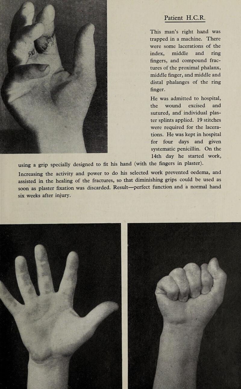using a grip specially designed to fit his hand (with This man’s right hand was trapped in a machine. There were some lacerations of the index, middle and ring fingers, and compound frac¬ tures of the proximal phalanx, middle finger, and middle and distal phalanges of the ring finger. He was admitted to hospital, the wound excised and sutured, and individual plas¬ ter splints applied. 19 stitches were required for the lacera¬ tions. He was kept in hospital for four days and given systematic penicillin. On the 14th day he started work, the fingers in plaster). Increasing the activity and power to do his selected work prevented oedema, and assisted in the healing of the fractures, so that diminishing grips could be used as soon as plaster fixation was discarded. Result—perfect function and a normal hand six weeks after injury.