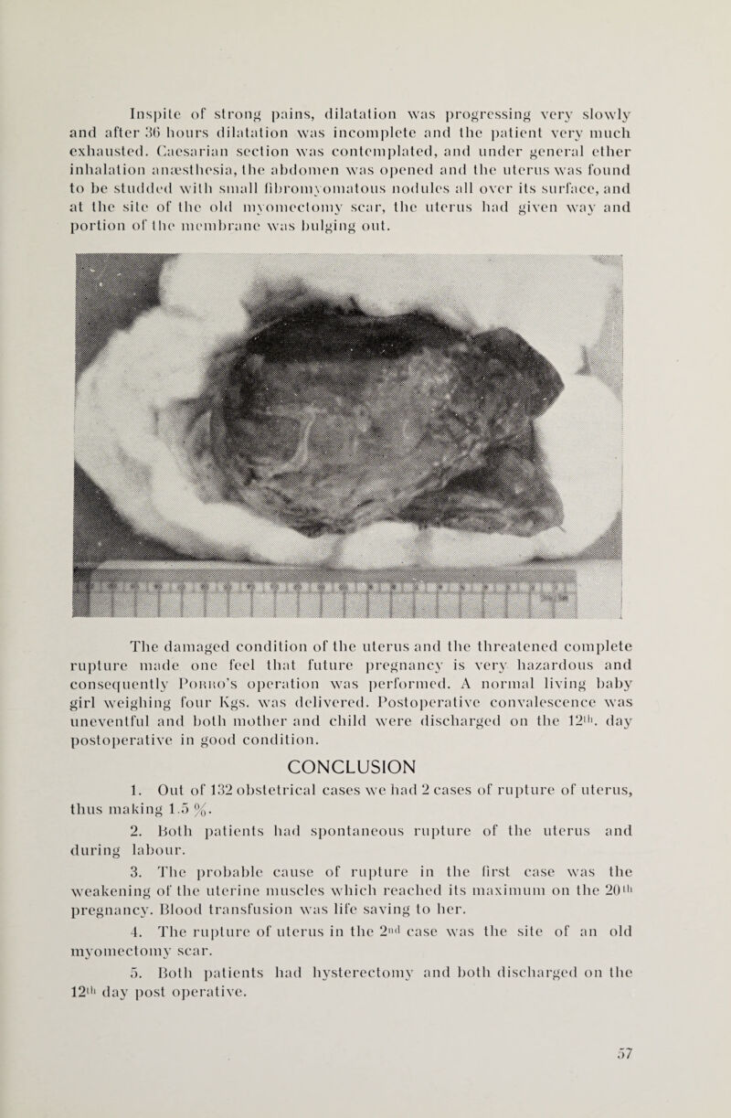 Inspite of strong pains, dilatation was progressing very slowly and after 36 hours dilatation was incomplete and the patient very much exhausted. Caesarian section was contemplated, and under general ether inhalation anaesthesia, the abdomen was opened and the uterus was found to be studded with small fibroin yomatous nodules all over its surface, and at the site of the old myomectomy scar, the uterus had given way and portion of the membrane was bulging out. The damaged condition of the uterus and the threatened complete rupture made one feel that future pregnancy is very hazardous and consequently Porho’s operation was performed. A normal living baby girl weighing four Kgs. was delivered. Postoperative convalescence was uneventful and both mother and child were discharged on the 12ll). day postoperative in good condition. CONCLUSION 1. Out of 132 obstetrical cases we had 2 cases of rupture of uterus, thus making 1.5 %. 2. Both patients had spontaneous rupture of the uterus and during labour. 3. The probable cause of rupture in the first case was the weakening of the uterine muscles which reached its maximum on the 20ltl pregnancy. Blood transfusion was life saving to her. 4. The rupture of uterus in the 2nd case was the site of an old myomectomy scar. 5. Both patients had hysterectomy and both discharged on the 12lh day post operative.