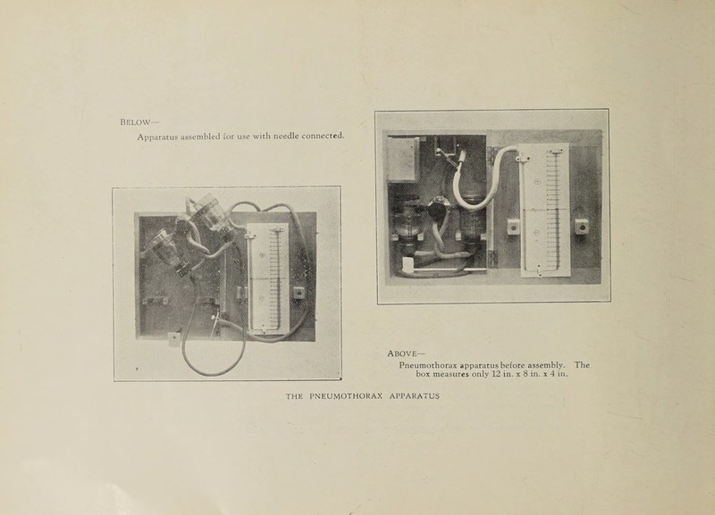 Below— THE PNEUMOTHORAX APPARATUS