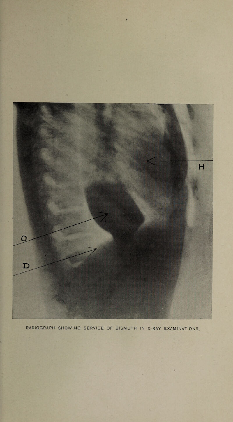 RADIOGRAPH SHOWING SERVICE OF BISMUTH IN X-RAY EXAMINATIONS