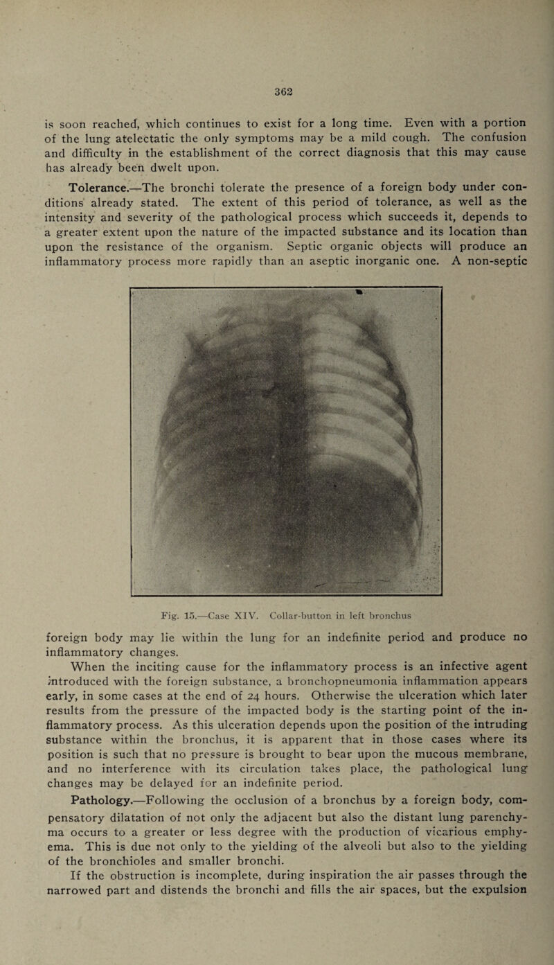 is soon reached, which continues to exist for a long time. Even with a portion of the lung atelectatic the only symptoms may be a mild cough. The confusion and difficulty in the establishment of the correct diagnosis that this may cause has already been dwelt upon. Tolerance.—The bronchi tolerate the presence of a foreign body under con¬ ditions already stated. The extent of this period of tolerance, as well as the intensity and severity of the pathological process which succeeds it, depends to a greater extent upon the nature of the impacted substance and its location than upon the resistance of the organism. Septic organic objects will produce an inflammatory process more rapidly than an aseptic inorganic one. A non-septic Fig. 15.—Case XIV. Collar-button in left bronchus foreign body may lie within the lung for an indefinite period and produce no inflammatory changes. When the inciting cause for the inflammatory process is an infective agent mtroduced with the foreign substance, a bronchopneumonia inflammation appears early, in some cases at the end of 24 hours. Otherwise the ulceration which later results from the pressure of the impacted body is the starting point of the in¬ flammatory process. As this ulceration depends upon the position of the intruding substance within the bronchus, it is apparent that in those cases where its position is such that no pressure is brought to bear upon the mucous membrane, and no interference with its circulation takes place, the pathological lung changes may be delayed for an indefinite period. Pathology.—Following the occlusion of a bronchus by a foreign body, com¬ pensatory dilatation of not only the adjacent but also the distant lung parenchy¬ ma occurs to a greater or less degree with the production of vicarious emphy- ema. This is due not only to the yielding of the alveoli but also to the yielding of the bronchioles and smaller bronchi. If the obstruction is incomplete, during inspiration the air passes through the narrowed part and distends the bronchi and fills the air spaces, but the expulsion