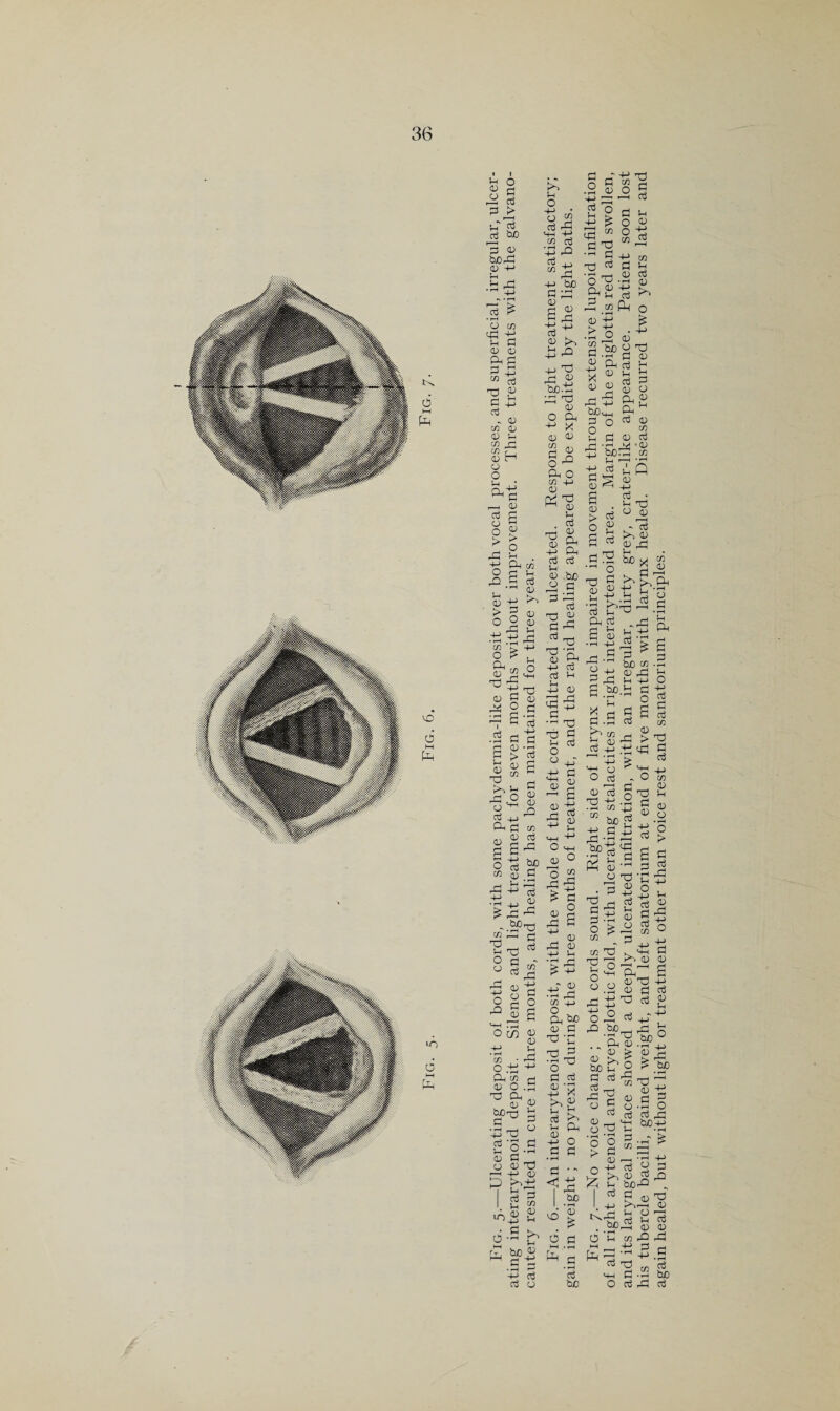 u o 0) 2 ^ is 1—I CO P > ^ be <1^ berC OJ +-> .b ^ ' ti T3 G M 0) o cO M cO • rH o tJS in W o; (u dn fH « To T3 s- ^ CD 'Ji 0-1 <V iH M ^ OT CD o o Ui d, cO CD o >■ H o; OD d b O TS > ^ o 2 d M U cO OD M-H +-> (n cO •+3 rO cO ij “ d +-> be fn d OJ To ^ CD >. Tsd -M d d d o; O d X CD 2 o; o^ d o cn -(-> CD rX d o;) cO OD d . d cO cO <D .be d a ^ « 4^ ^ O d c« o *■2  !S 4-> !h odd d ^ P d OD o; CD d d d s ^ d CO o d ^ d ■ M OD O P i-H cj •+J a • i-H cO OD d • fH I o3 a- ., p B > I « d b rO P OD OD d O O P 4_J d b CO OD P OD o C/D QJ CO d ^ 1—^ 5 + p d ^ OD ^d^ .5fd '—' P iS 03 ^ Op O P S '~‘ 5 d S « 2 p o d^ a ^ -rH O CO <1^ OD +J CO ■ d Od ^ OD o d d d ^ OD Md ^ dd B ‘o '-' -H <1^ O OD d o-j OD P dd I P 3 I 2 CO •/^d a o d p ' •rH d sS !-l o CD P OD Dr! ^ ^ P b p CO (d d O CO P P OD ^ TS P P d CD ^ u CD ^ P OD g r-, d OD -M S-i ■> > +-> d <1^ d (/) o d ^ OD P d d d ^ p p dx ba ^ b IH d 4-> O P P • t-H ■ p . r f d be d OD OD ^P d <e b d ':a d be<4_i p o d p p OD a > p P OD • f—( k> bed S 0) 03 u o d 2 p d ^ d - p u OD d w 2 ' a ^ b fid ■'-' o t3 Pi ^ OD V-l _ +-> 4-> !h d P Dh ^ d P . a o is d d ^ p p d be a d a a .a^d X a p p d p rP ^ d b o ^ OD 13 a d d -2 (n o) ap H -4-» -1 fa a Cp p pd o ^ CD d 03 u (V o ^ p r~H Cl o3 u bjo ^ p d * ^ ^ -M P P o CO 7D d 12 , 8.2 s d iid o O rP d be^ •p d) . . d OD OD > Sd^I rPd OD S p ., p PD rrH '4-1 CD d Jh •I-t ^ g a “ o 8 T3 d >,o d dh be I P P 4j t>' bid a bed Op O CO d P d • ^ p be p x) -M Ch O o3 his tubercle bacilli, gained weight, and left sanatorium at end of five months with larynx healed. Disease recurred two years later again healed, but without light or treatment other than voice rest and sanatorium principles.