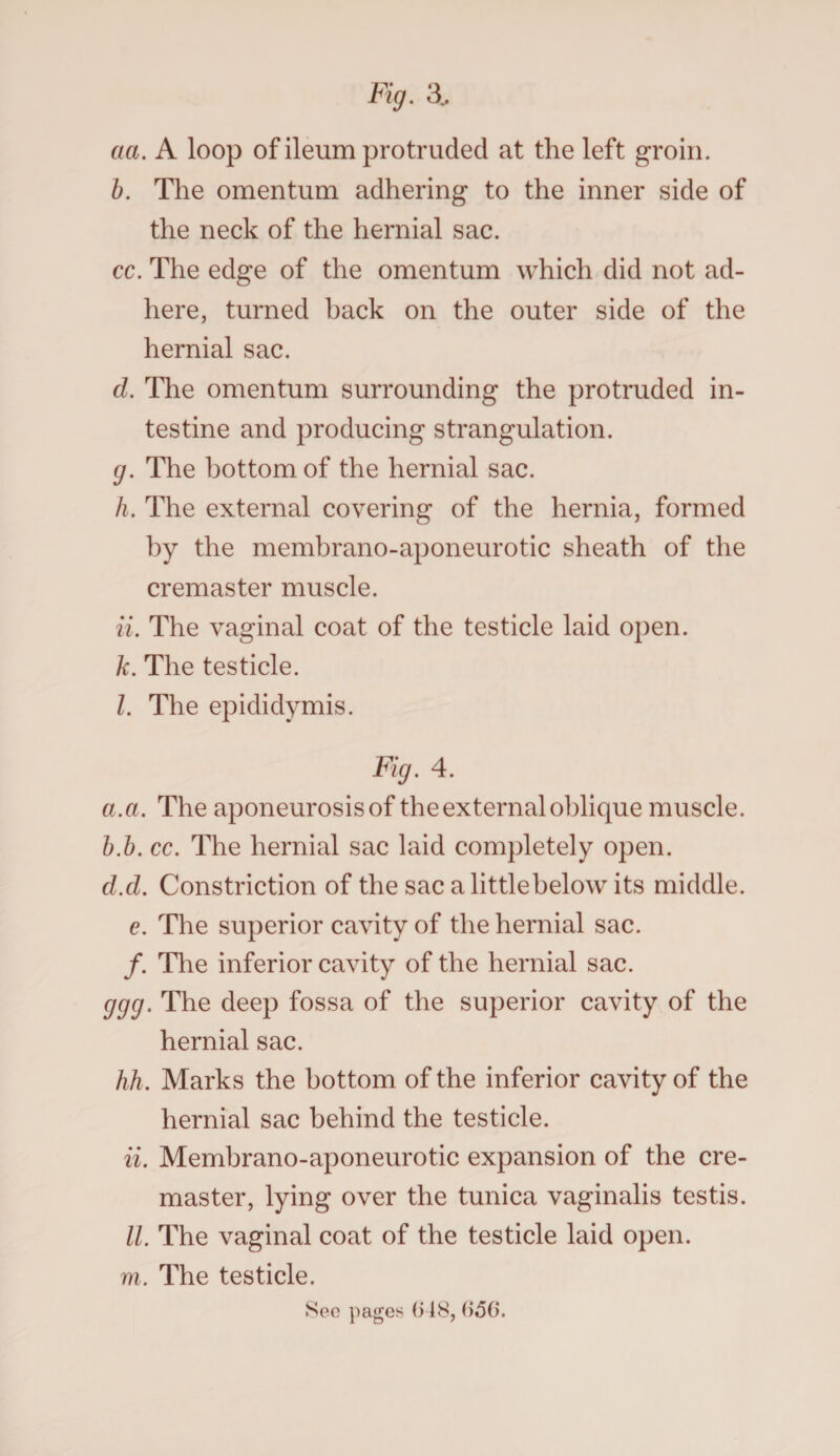Fig. 3, aa. A loop of ileum protruded at the left groin. b. The omentum adhering to the inner side of the neck of the hernial sac. cc. The edge of the omentum which did not ad¬ here, turned hack on the outer side of the hernial sac. d. The omentum surrounding the protruded in¬ testine and producing strangulation. g. The bottom of the hernial sac. h. The external covering of the hernia, formed by the membrano-aponeurotic sheath of the cremaster muscle. ii. The vaginal coat of the testicle laid open. k. The testicle. l. The epididymis. Fig. 4. a. a. The aponeurosis of the external oblique muscle. b. b. cc. The hernial sac laid completely open. d.d. Constriction of the sac alittlebelow its middle. e. The superior cavity of the hernial sac. /. The inferior cavity of the hernial sac. ggg. The deep fossa of the superior cavity of the hernial sac. hh. Marks the bottom of the inferior cavity of the hernial sac behind the testicle. ii. Membrano-aponeurotic expansion of the cre¬ master, lying over the tunica vaginalis testis. II. The vaginal coat of the testicle laid open. m. The testicle. Sec pages (518, ()56‘.