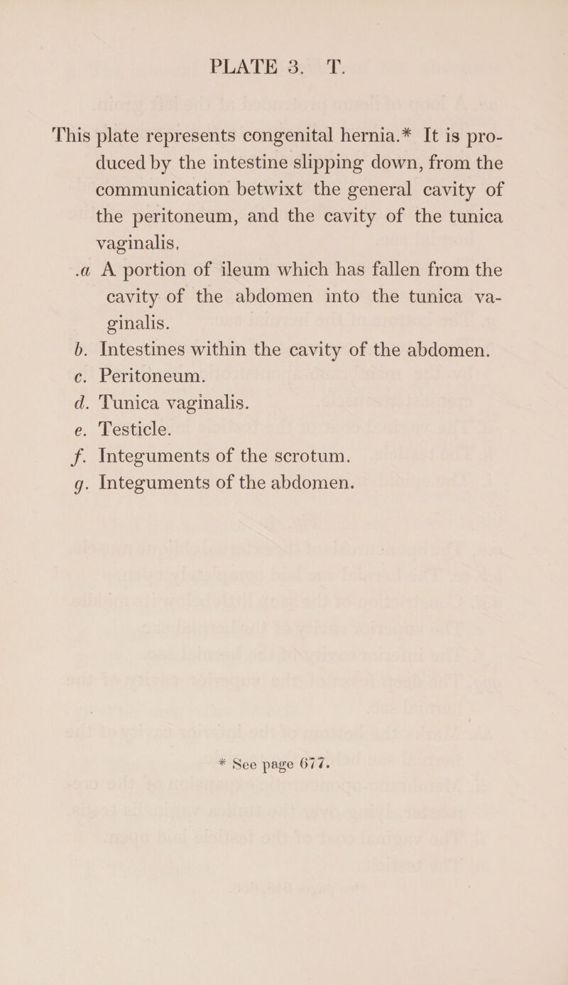 This plate represents congenital hernia.# It is pro¬ duced by the intestine slipping down, from the communication betwixt the general cavity of the peritoneum, and the cavity of the tunica vaginalis, .a A portion of ileum which has fallen from the cavity of the abdomen into the tunica va¬ ginalis. b. Intestines within the cavity of the abdomen. c. Peritoneum. d. Tunica vaginalis. e. Testicle. /. Integuments of the scrotum. g. Integuments of the abdomen.