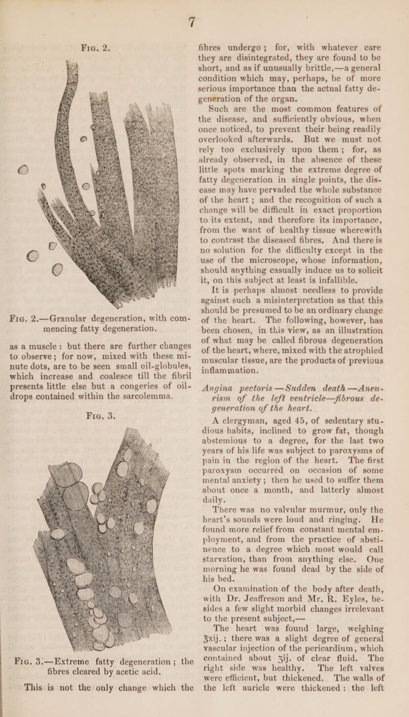 Fig. 2. mencing fatty degeneration. as a muscle : but there are further changes to observe; for now, mixed with these mi¬ nute dots, are to be seen small oil-globules, which increase and coalesce till the fibril presents little else but a congeries of oil - drops contained within the sarcolemma. Fig. 3. Fig. 3.—Extreme fatty degeneration ; the fibres cleared by acetic acid. This is not the only change which the fibres undergo ; for, with whatever care they are disintegrated, they are found to be short, and as if unusually brittle,—a general condition which may, perhaps, be of more serious importance than the actual fatty de¬ generation of the organ. Such are the most common features of the disease, and sufficiently obvious, when once noticed, to prevent their being readily overlooked afterwards. But we must not rely too exclusively upon them ; for, as already observed, in the absence of these little spots marking the extreme degree of fatty degeneration in single points, the dis¬ ease may have pervaded the whole substance of the heart ; and the recognition of such a change will be difficult in exact proportion to its extent, and therefore its importance, from the want of healthy tissue wherewith to contrast the diseased fibres. And there is no solution for the difficulty except in the use of the microscope, whose information, should anything casually induce us to solicit it, on this subject at least is infallible. It is perhaps almost needless to provide against such a misinterpretation as that this should be presumed to be an ordinary change of the heart. The following, however, has been chosen, in this view, as an illustration of what may be called fibrous degeneration of the heart, where, mixed with the atrophied muscular tissue, are the products of previous inflammation. Angina pectoris—Sudden death—Aneu¬ rism of the left ventricle—fibrous de¬ gen eration of the heart. A clergyman, aged 45, of sedentary stu¬ dious habits, inclined to grow fat, though abstemious to a degree, for the last two years of his life was subject to paroxysms of pain in the region of the heart. The first paroxysm occurred on occasion of some mental anxiety; then he used to suffer them about once a month, and latterly almost daily. There was no valvular murmur, only the heart’s sounds were loud and ringing. He found more relief from constant mental em¬ ployment, and from the practice of absti¬ nence to a degree which most would call starvation, than from anything else. One morning he was found dead by the side of his bed. On examination of the body after death, with Dr. Jeaffreson and Mr. R. Eyles, be¬ sides a few slight morbid changes irrelevant to the present subject,— The heart was found large, weighing ^xij. ; there was a slight degree of general vascular injection of the pericardium, which contained about 5ij. of clear fluid. The right side was healthy. The left valves were efficient, but thickened. The walls of the left auricle were thickened : the left