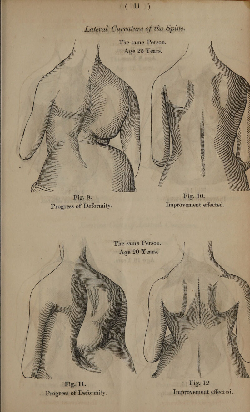 Fig. 9. Progress of Deformity. Fig. 10. Improvement effected. Lateral Curvature of the Spine. Person. Years. , Fig. 11. Person. Years. Fig. 12