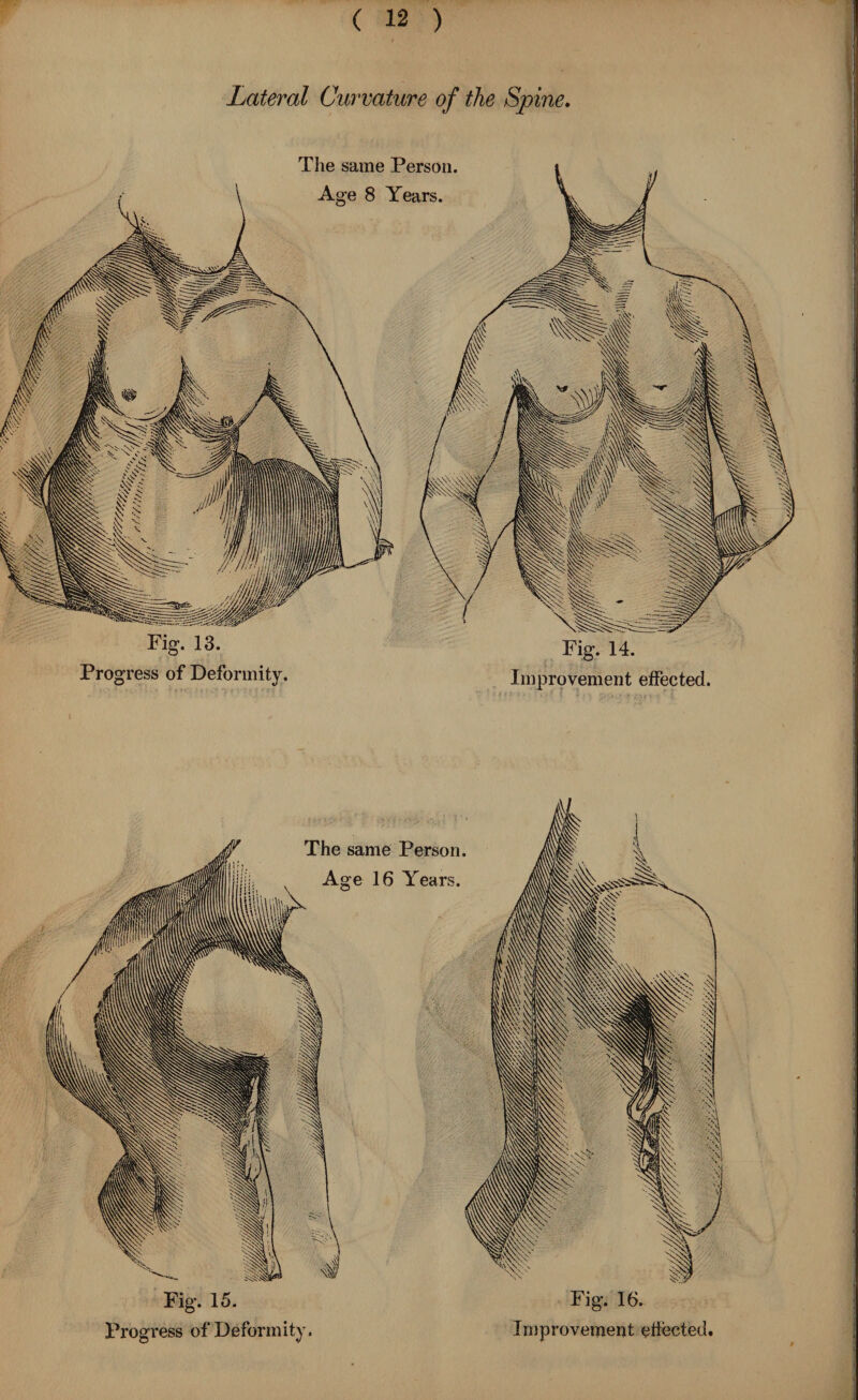 Lateral Curvature of the Spine. The same Person. Age 8 Years. Fig. 13. Progress of Deformity. Fig. 14. Improvement effected. The same Person Age 16 Years. Fig. 15. Fig. 16.